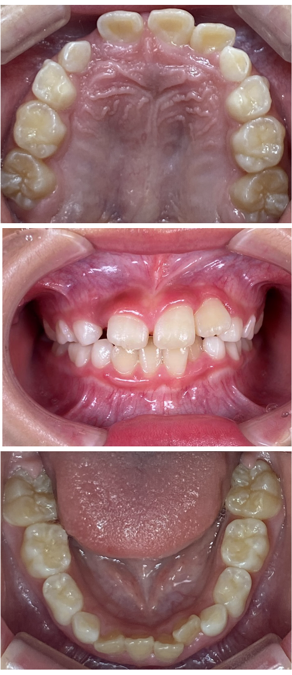 歯がガタガタに並んでいるのが気になる（叢生小児矯正症例）