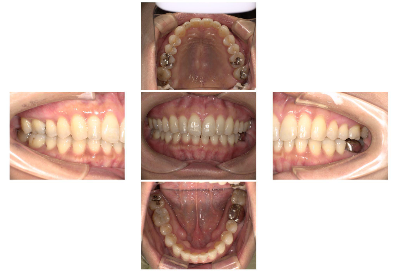 上顎前突(上の前歯が出ているのが気になる)3