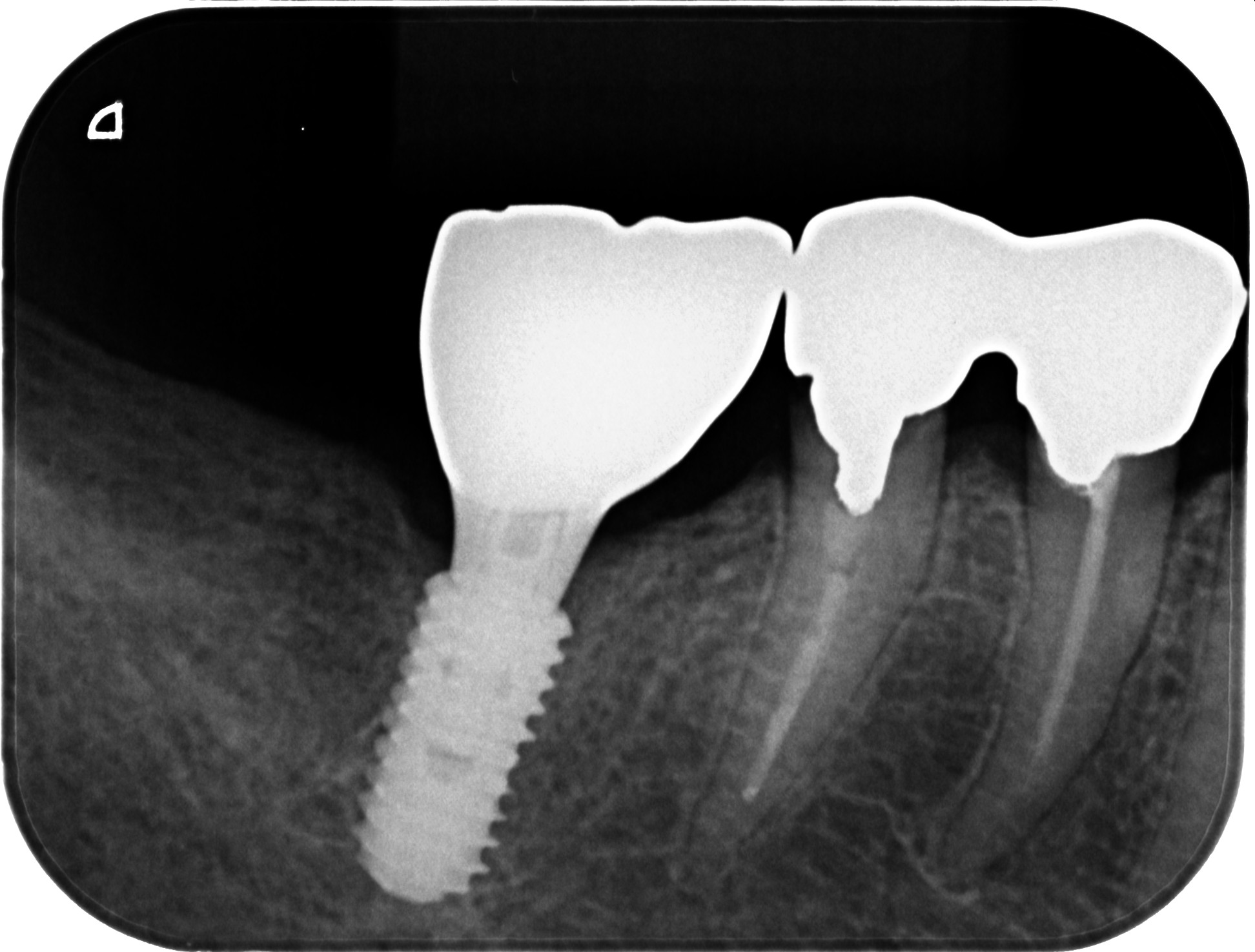 インプラント症例｜右下の被せものがとれてしまった