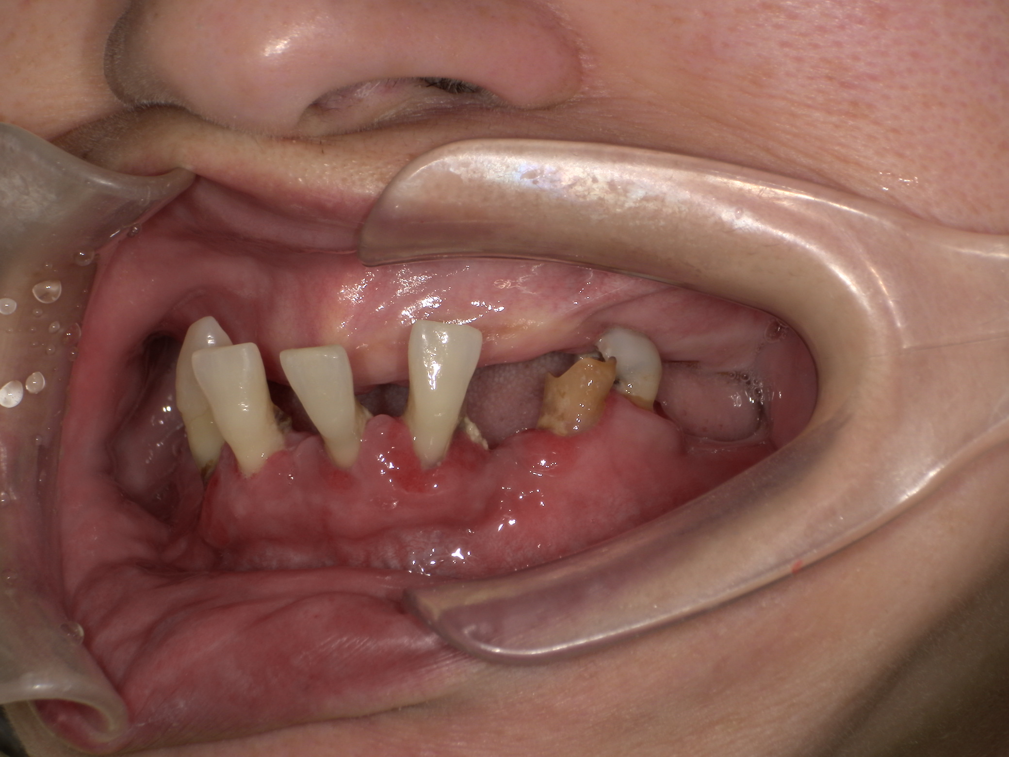 ノンクラスプ義歯症例｜噛めなくて困っている。入れ歯使っていない。