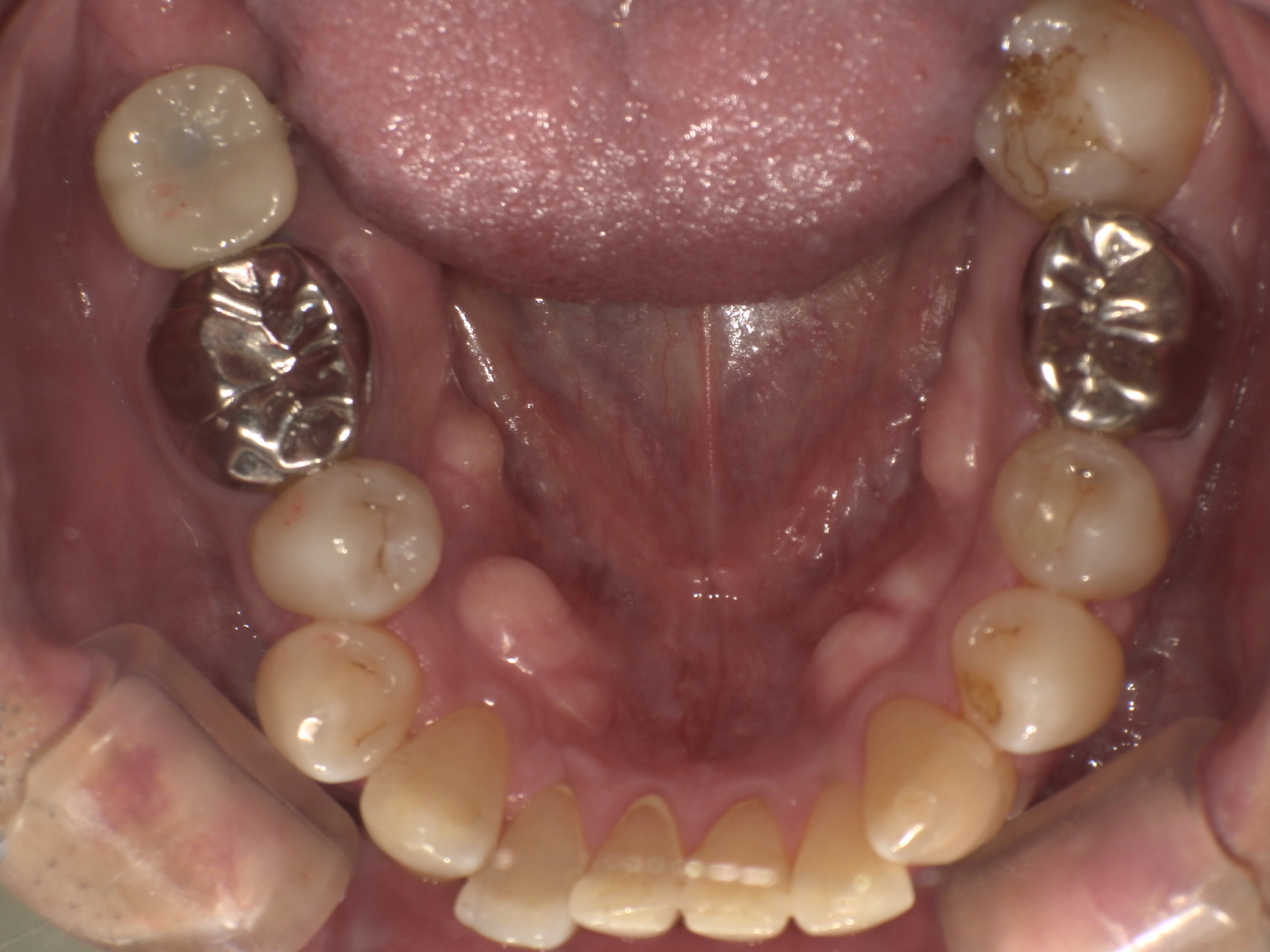 ソケットプリザベーション＆インプラント症例｜右下の奥歯が何もしなくても痛い6