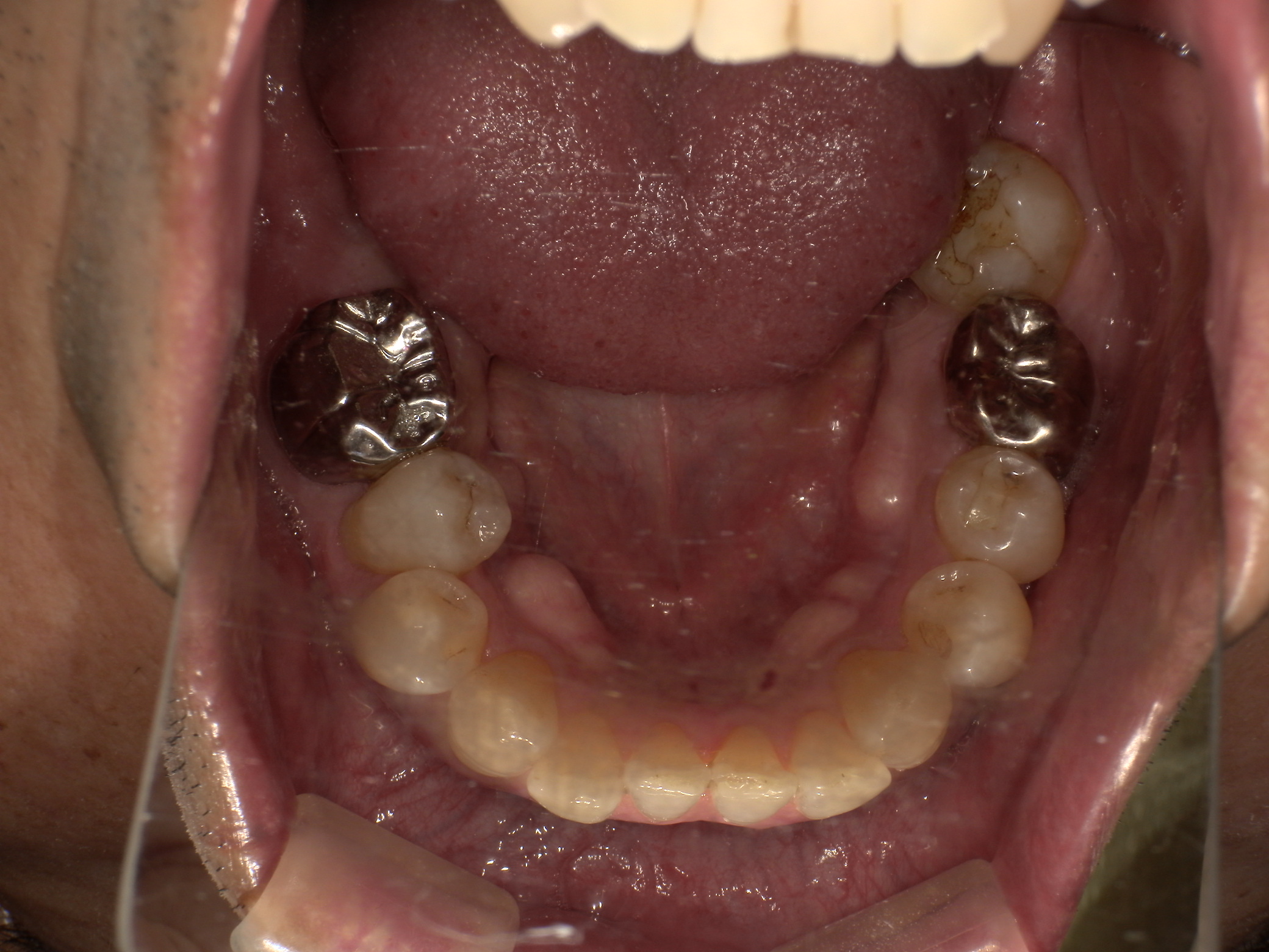 ソケットプリザベーション＆インプラント症例｜右下の奥歯が何もしなくても痛い