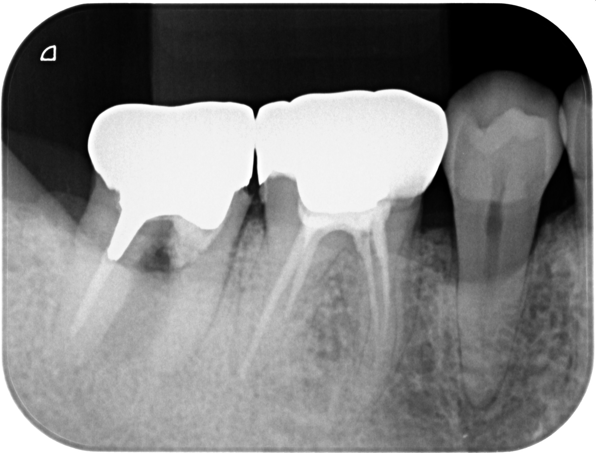 ソケットプリザベーション＆インプラント症例｜右下の奥歯が何もしなくても痛い1