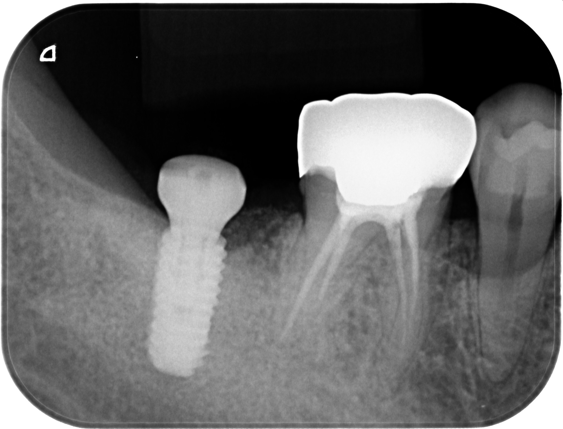 ソケットプリザベーション＆インプラント症例｜右下の奥歯が何もしなくても痛い3