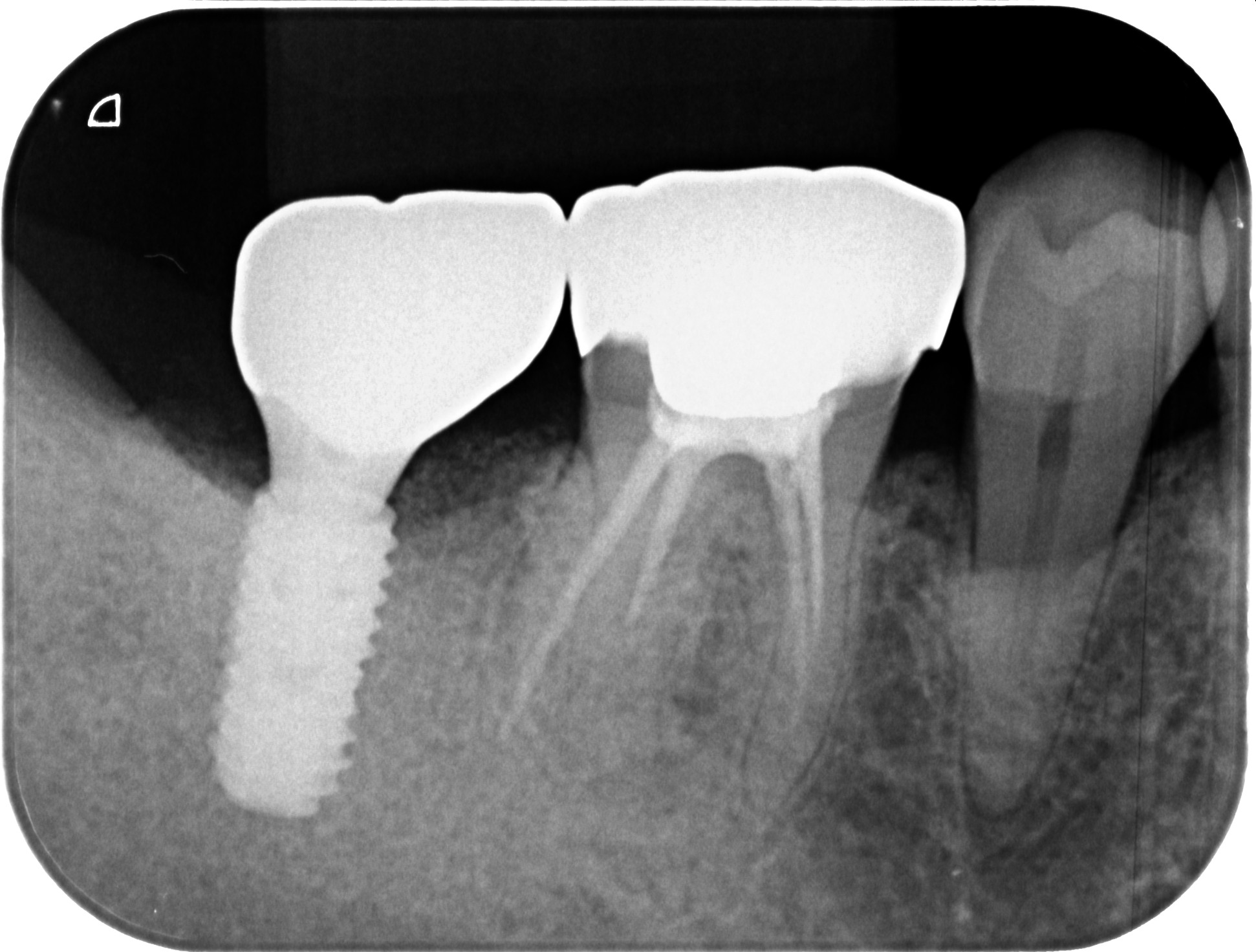 ソケットプリザベーション＆インプラント症例｜右下の奥歯が何もしなくても痛い4