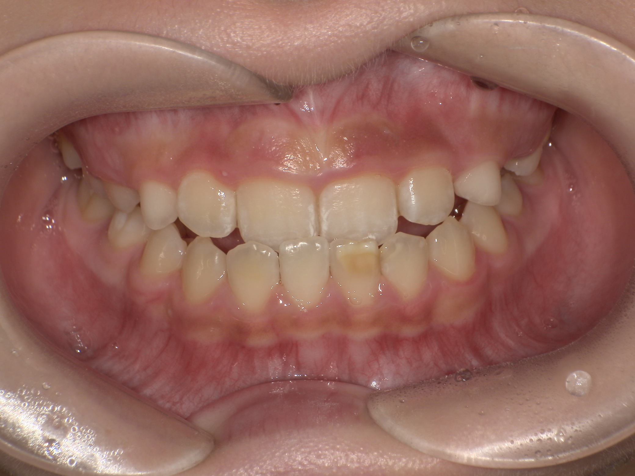 プレオルソ症例｜前歯が反対になっている歯並びが気になる