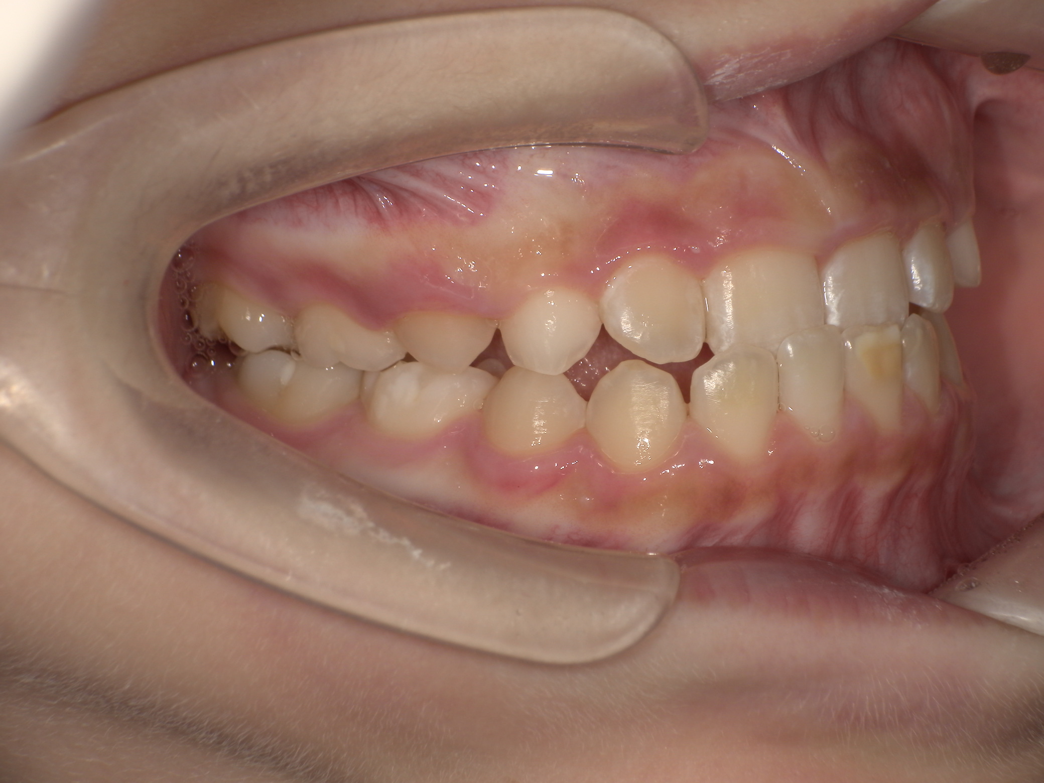 プレオルソ症例｜前歯が反対になっている歯並びが気になる2