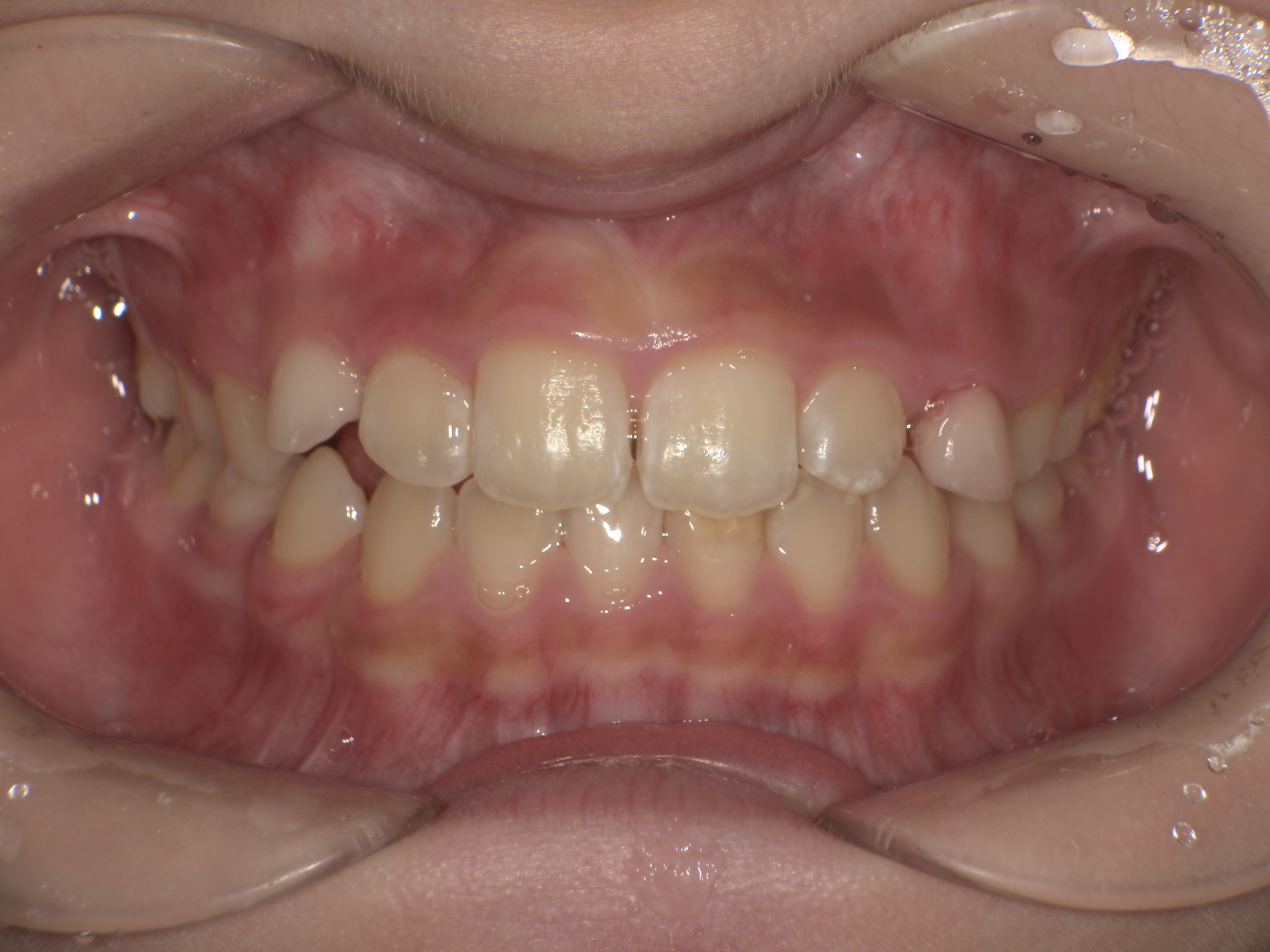 プレオルソ症例｜前歯が反対になっている歯並びが気になる3