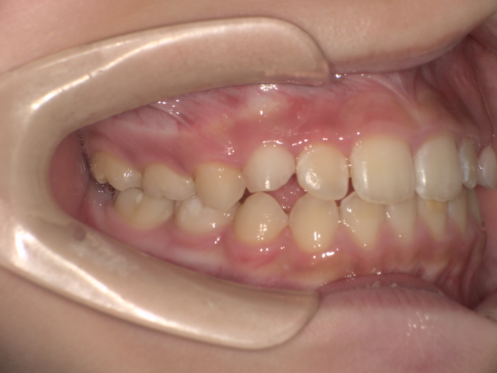 プレオルソ症例｜前歯が反対になっている歯並びが気になる4