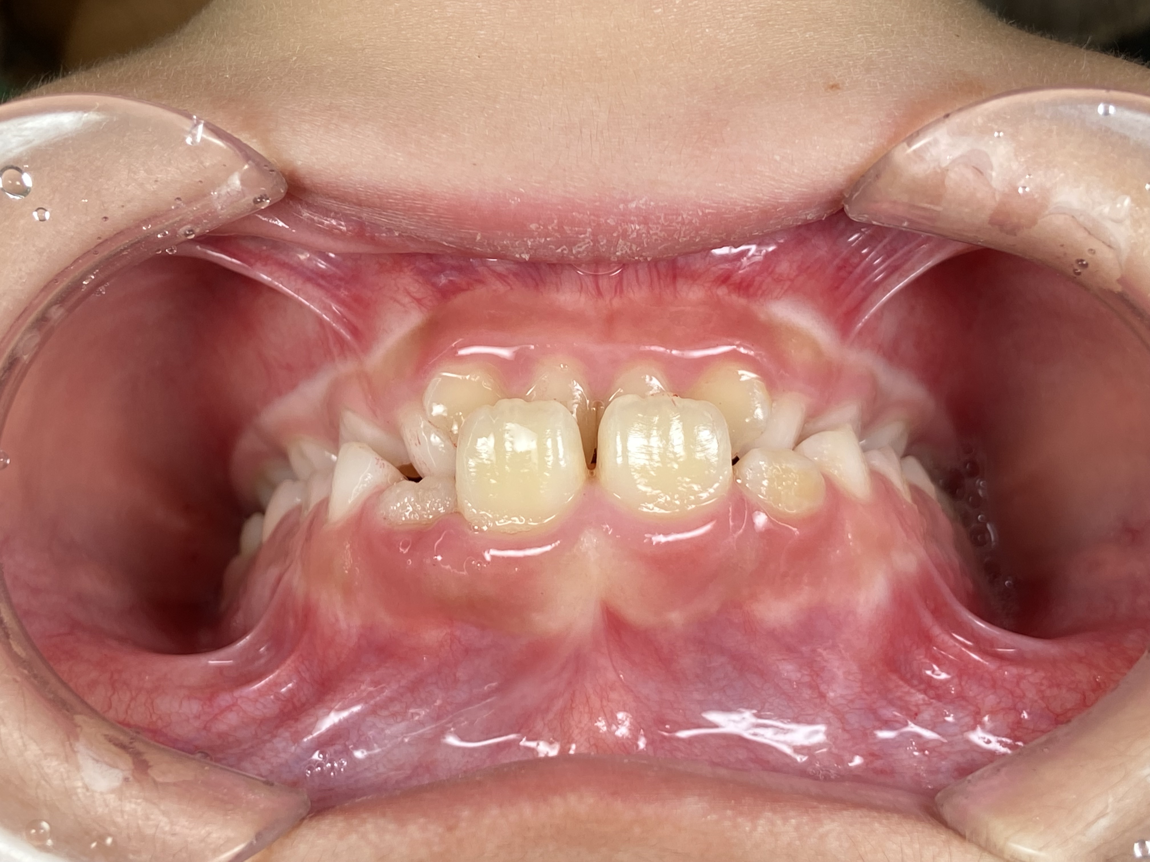 インビザラインファースト症例｜上の前歯に隙間があって気になる