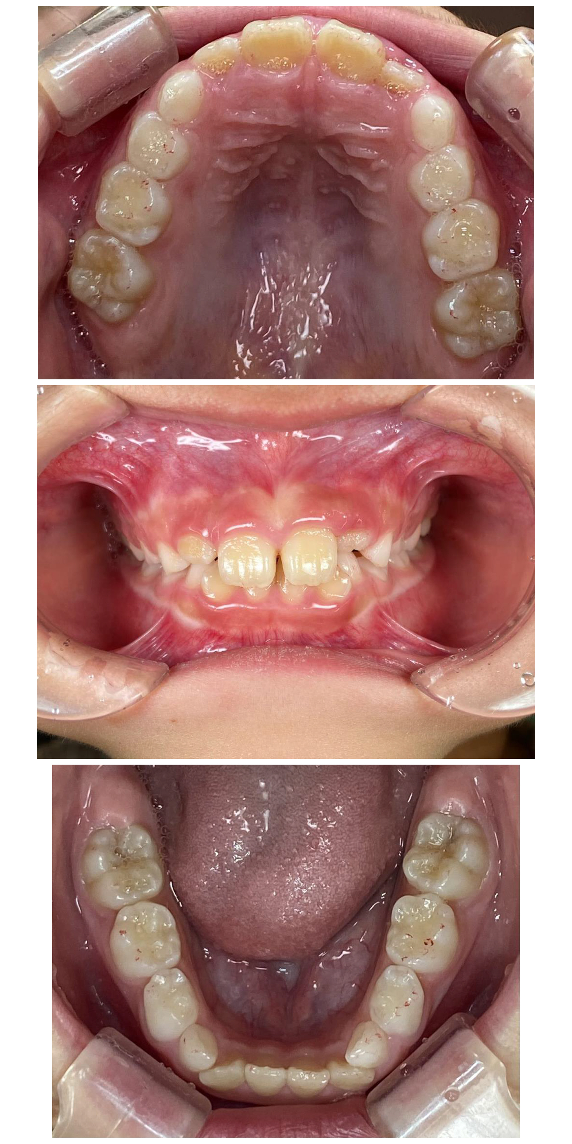 インビザラインファースト症例｜上の前歯に隙間があって気になる1