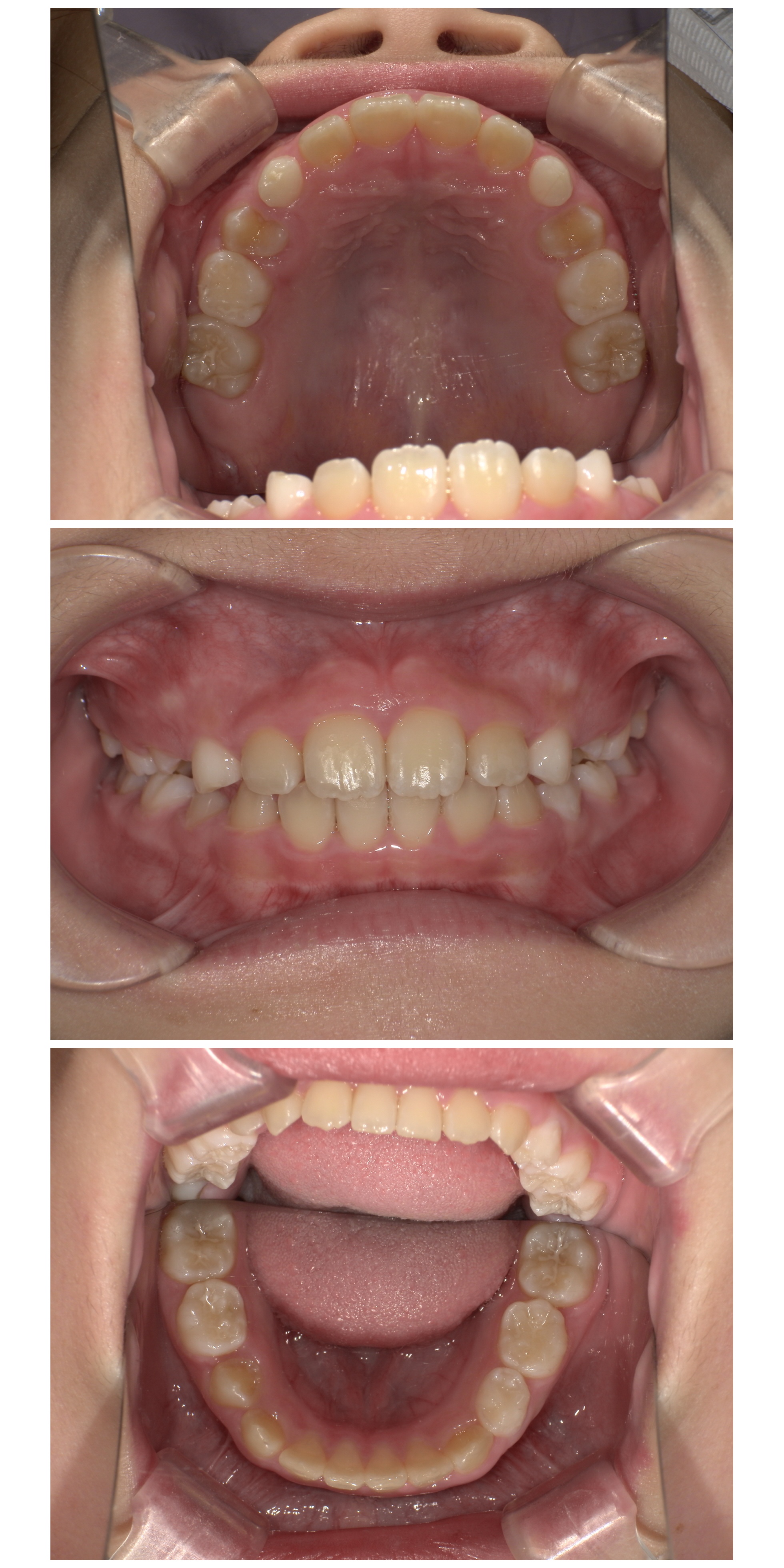 インビザラインファースト症例｜上の前歯に隙間があって気になる3