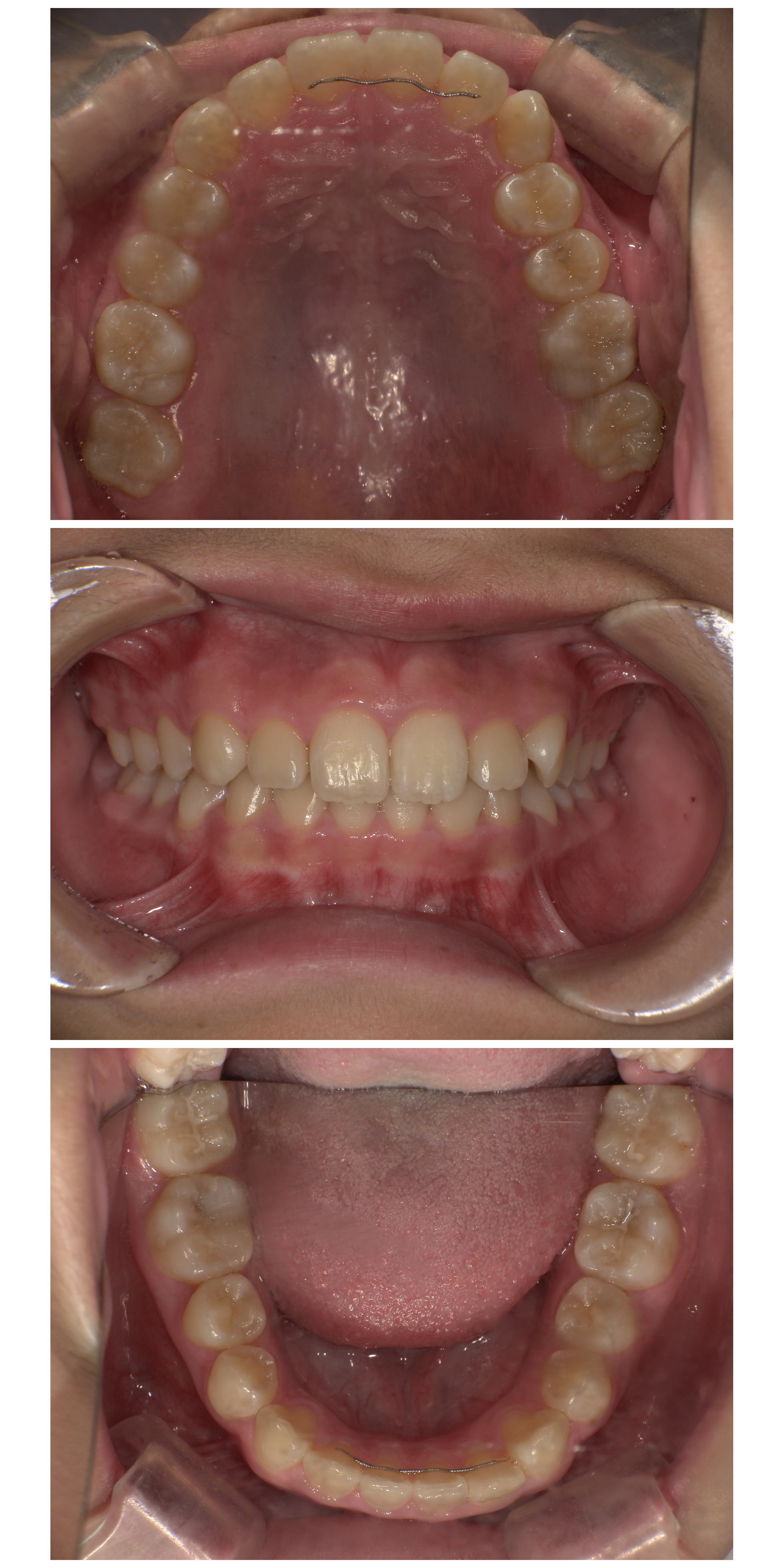 インビザラインファースト症例｜上の前歯に隙間があって気になる4