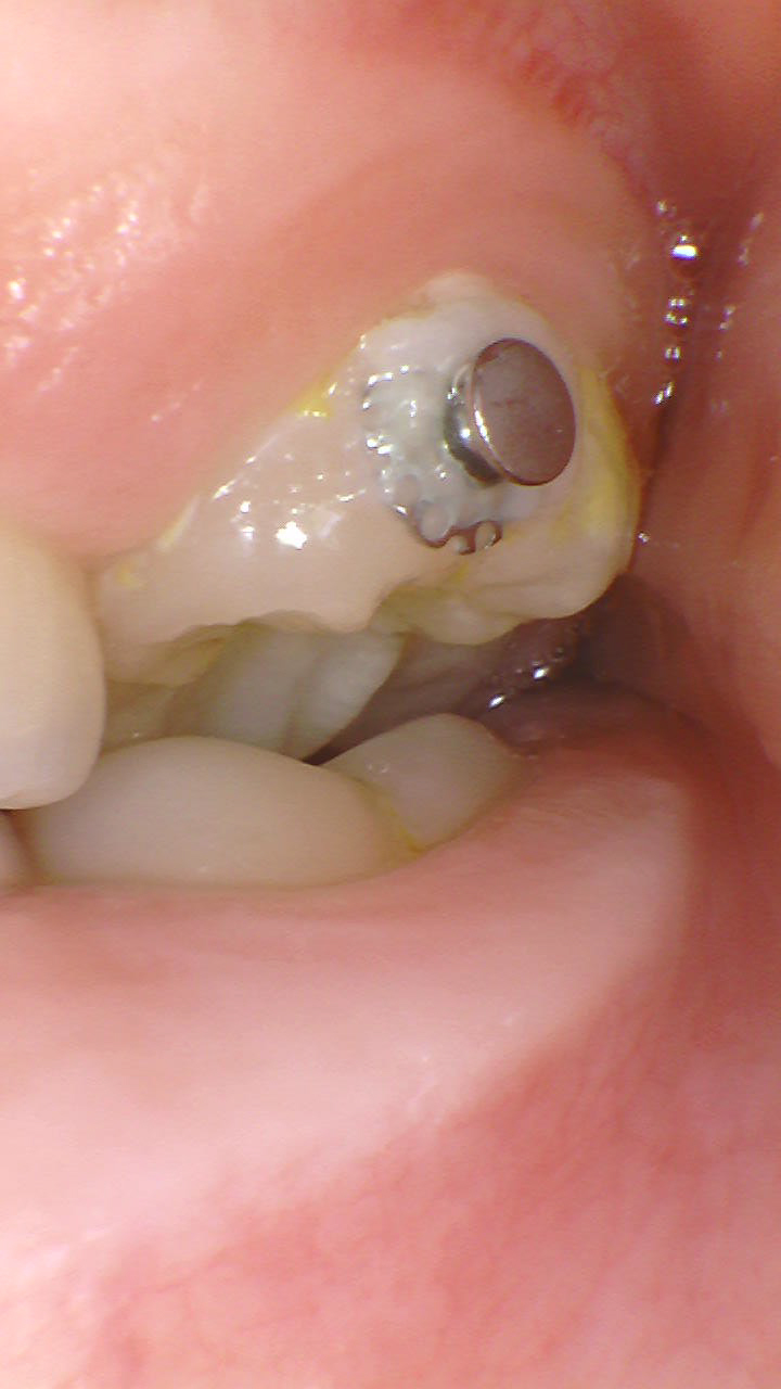 部分矯正症例｜左の奥歯がかみ合っていない（シザーズバイト）5