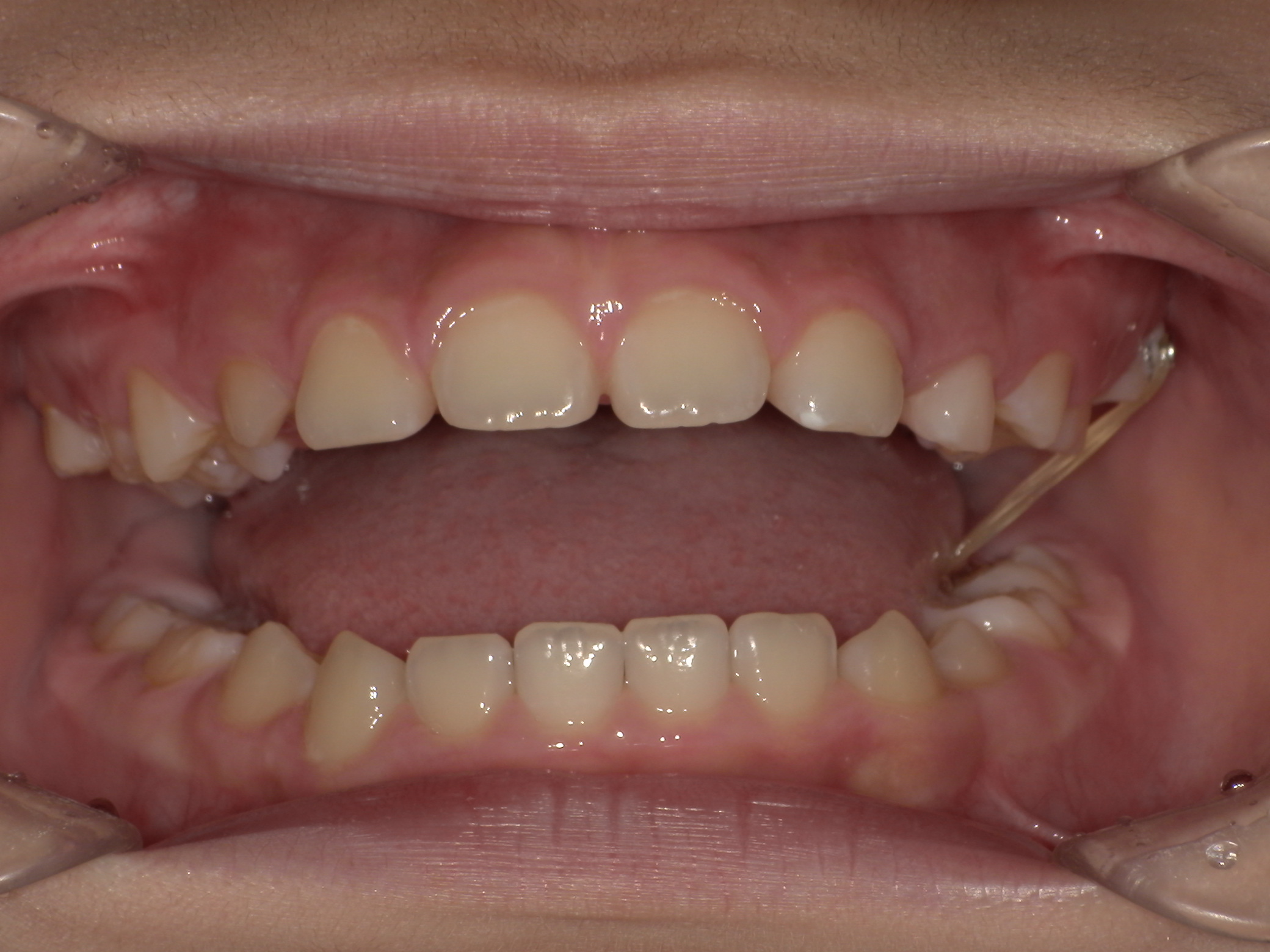 部分矯正症例｜左の奥歯がかみ合っていない（シザーズバイト）6