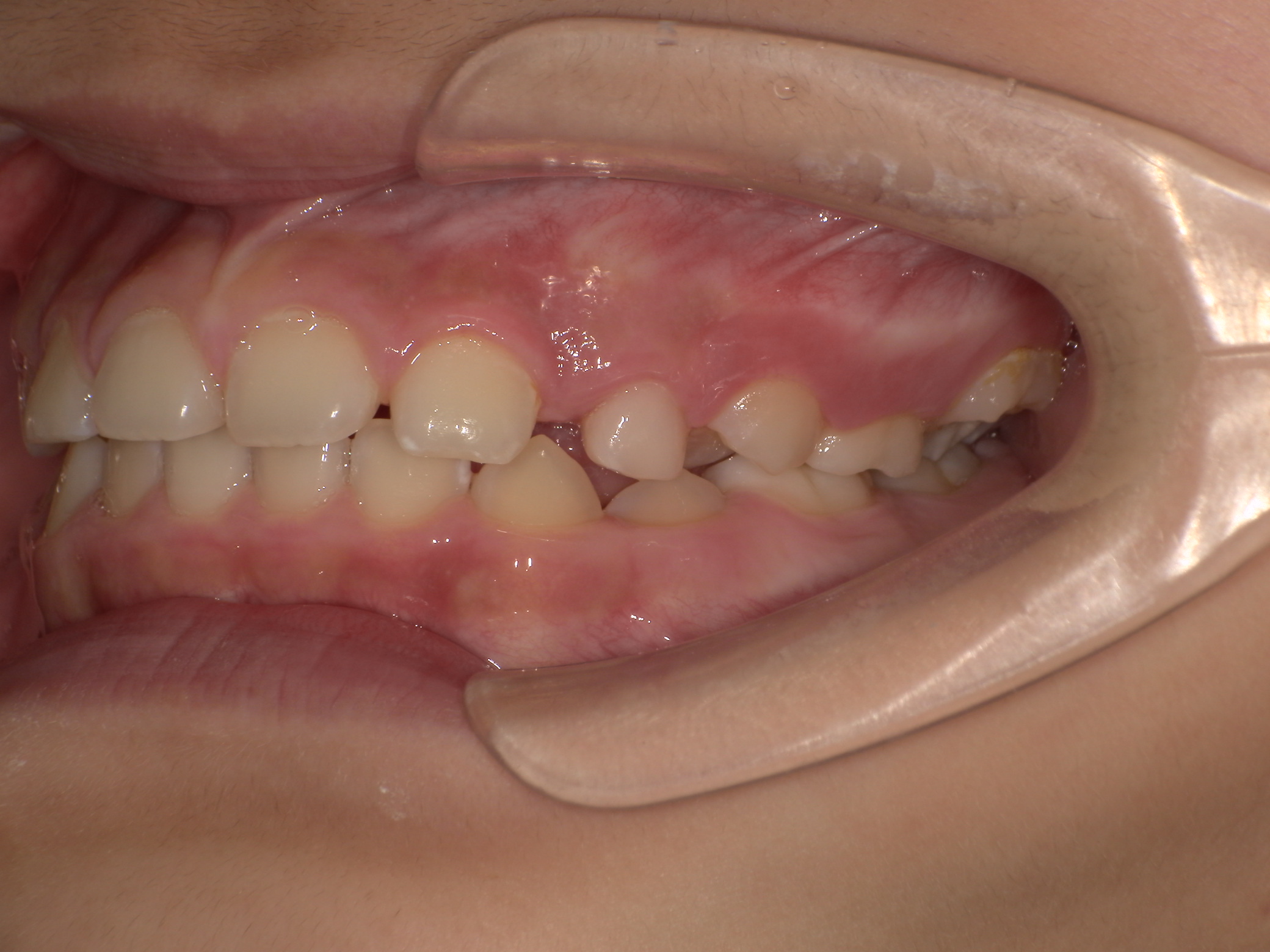 部分矯正症例｜左の奥歯がかみ合っていない（シザーズバイト）1