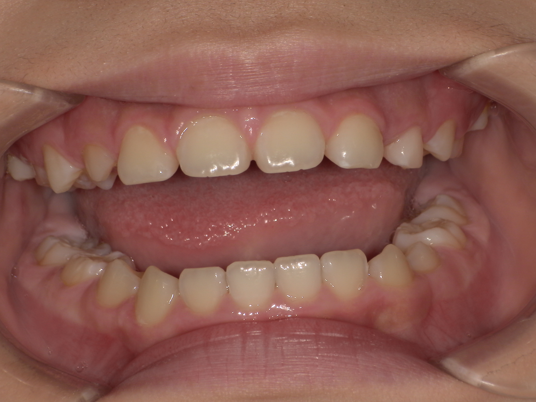 部分矯正症例｜左の奥歯がかみ合っていない（シザーズバイト）2