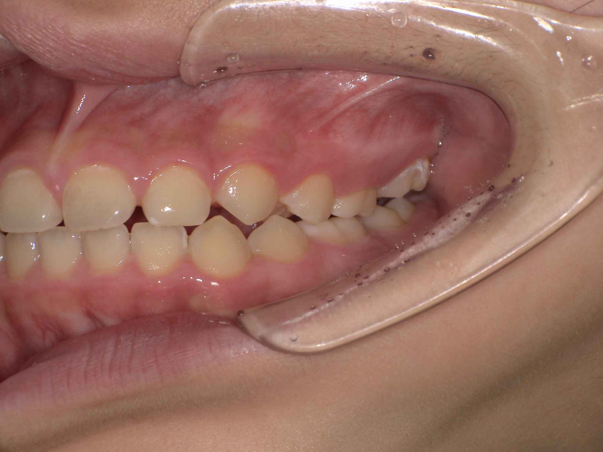 部分矯正症例｜左の奥歯がかみ合っていない（シザーズバイト）3
