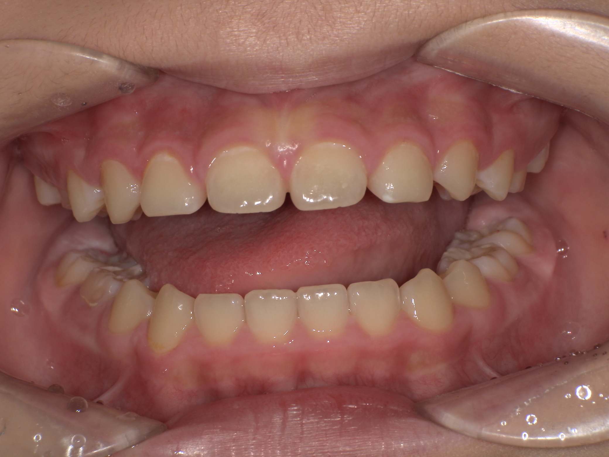 部分矯正症例｜左の奥歯がかみ合っていない（シザーズバイト）4