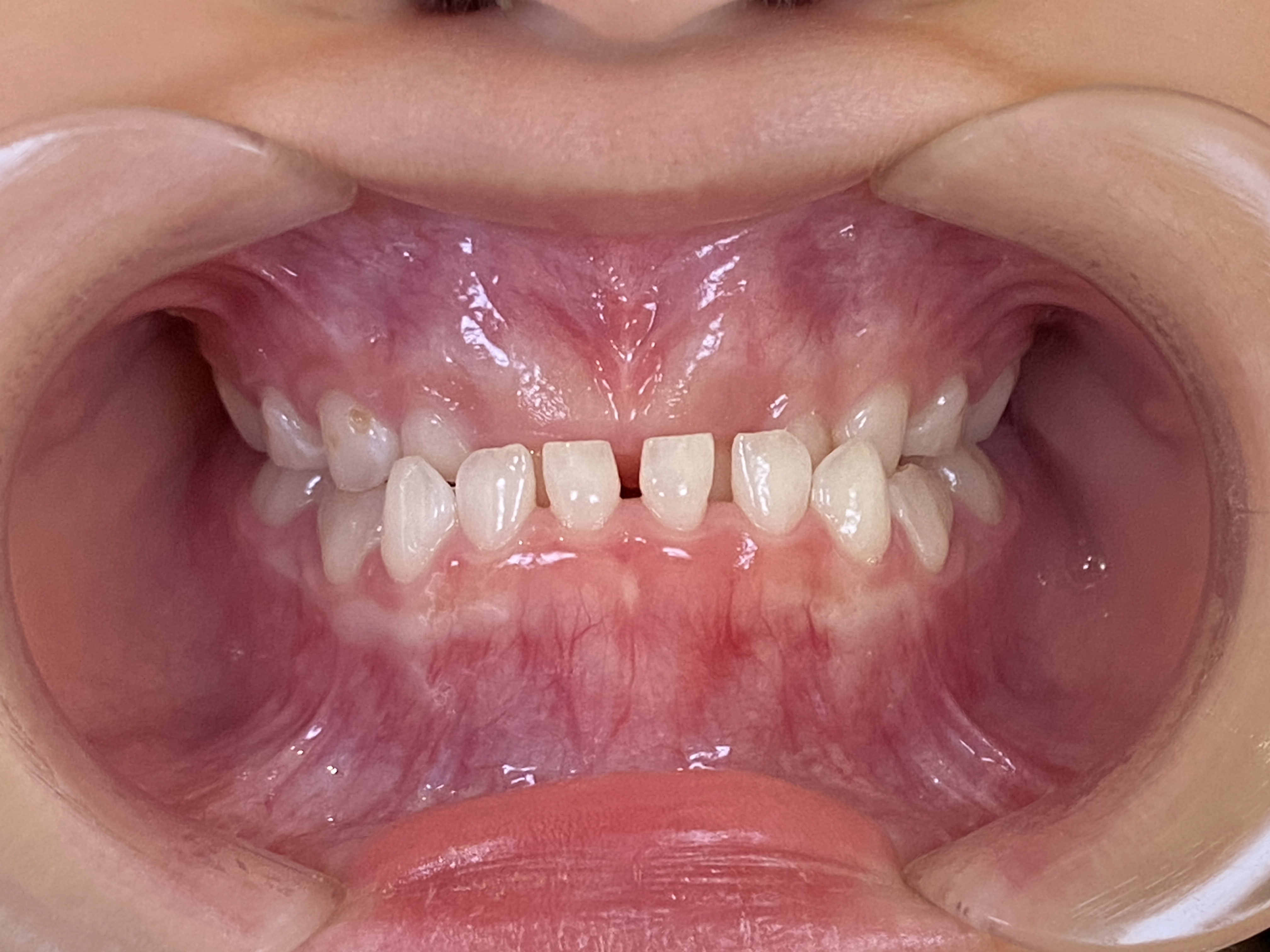 プレオルソ症例｜下の前歯が出ているのが気になる