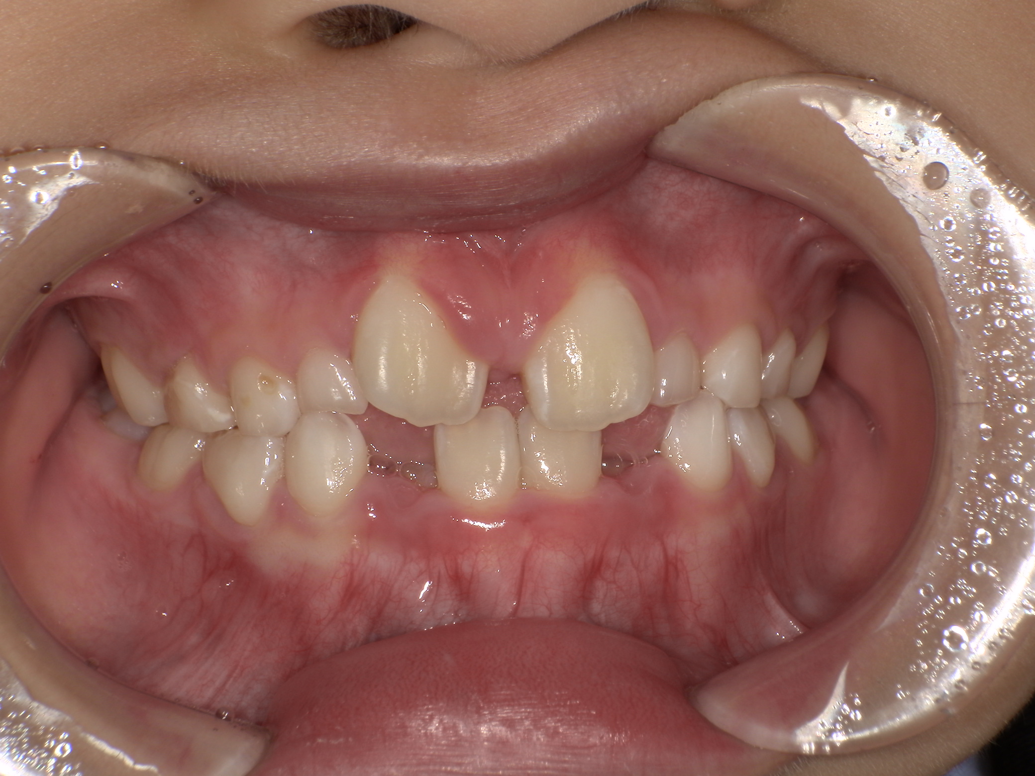 プレオルソ症例｜下の前歯が出ているのが気になる2