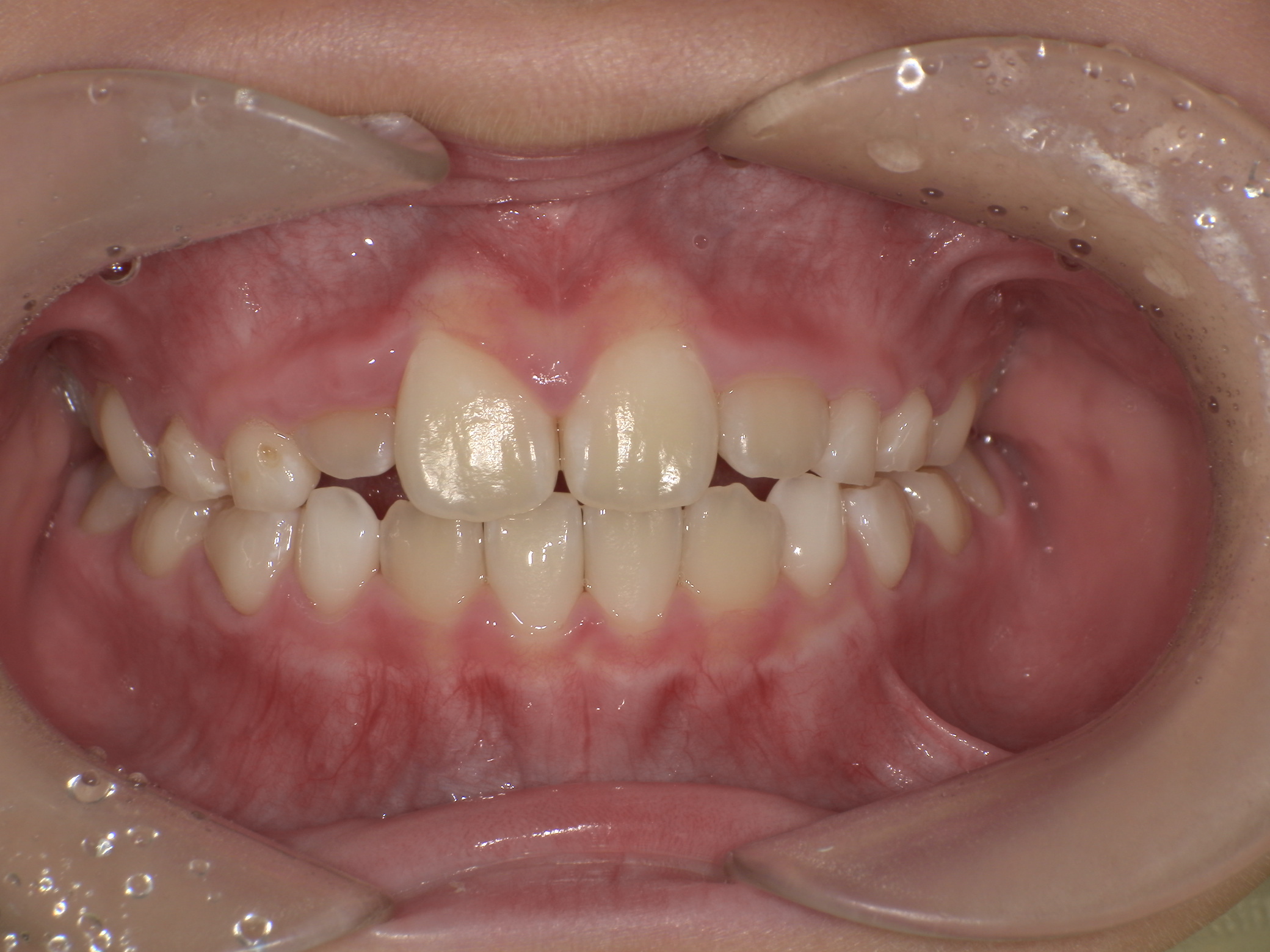 プレオルソ症例｜下の前歯が出ているのが気になる3