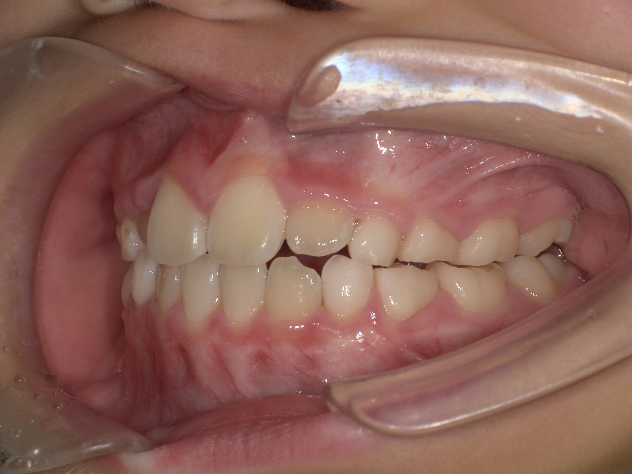 プレオルソ症例｜下の前歯が出ているのが気になる4