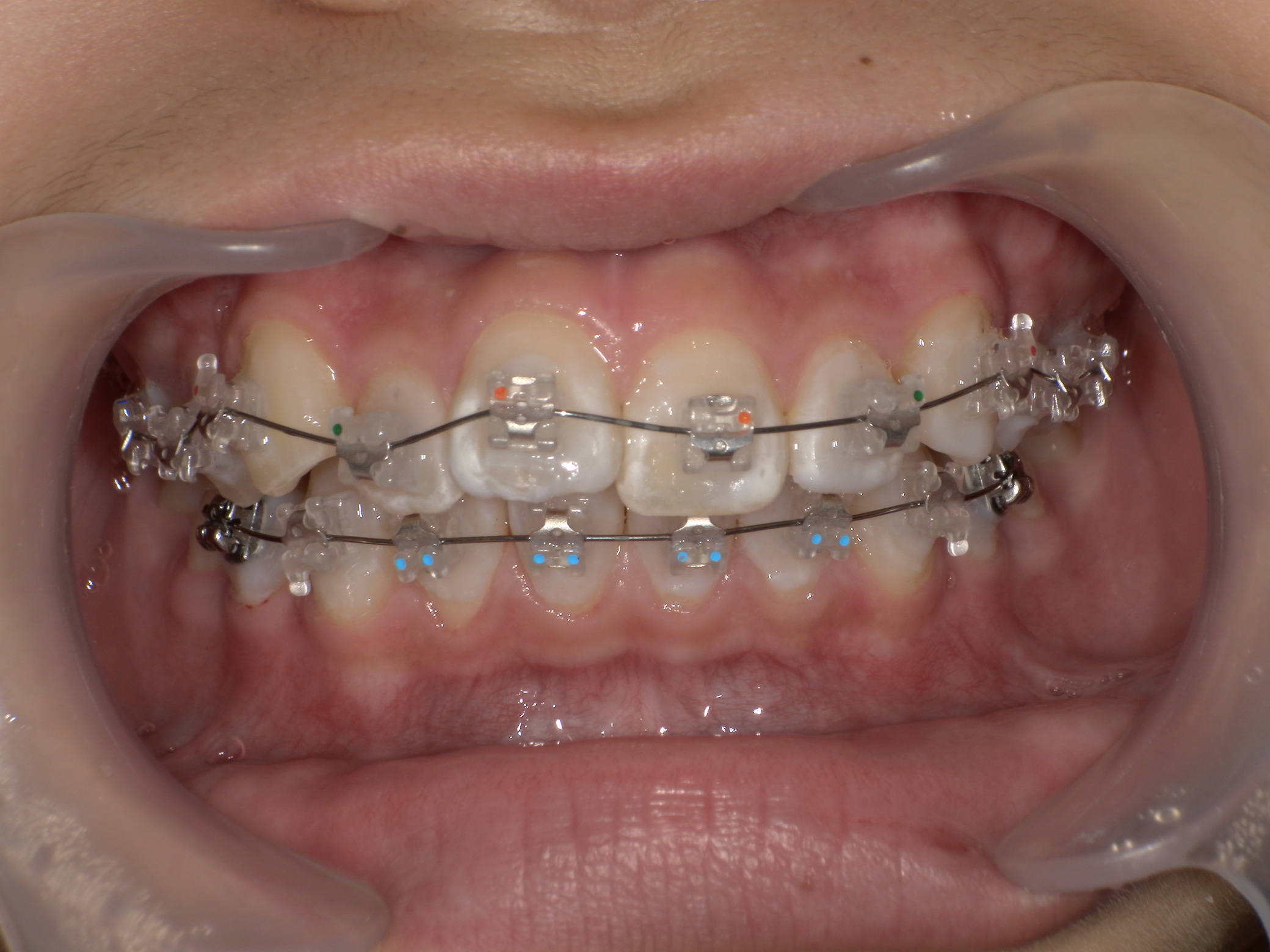 部分矯正症例｜前歯のガタガタが気になる