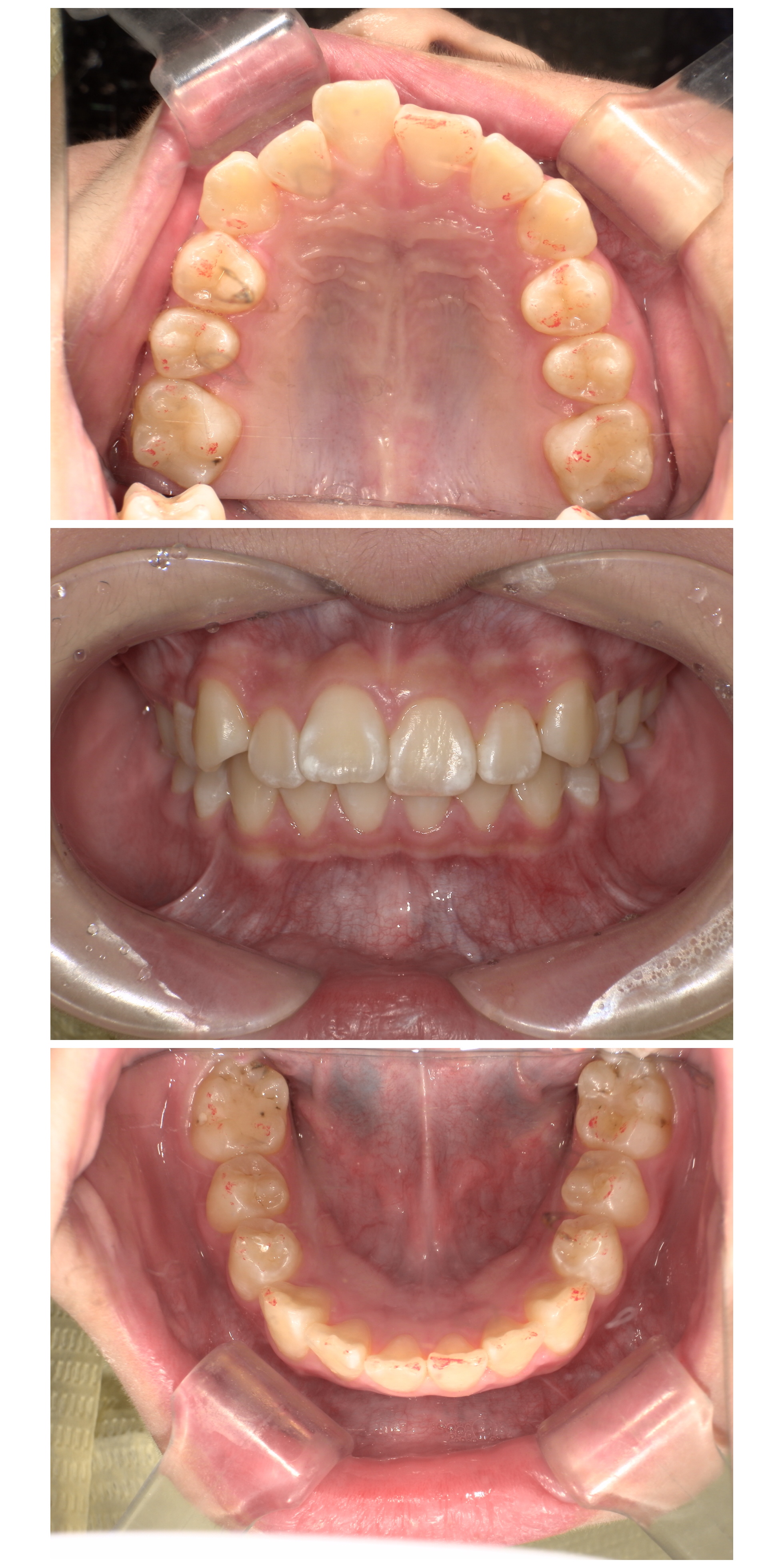 部分矯正症例｜前歯のガタガタが気になる1
