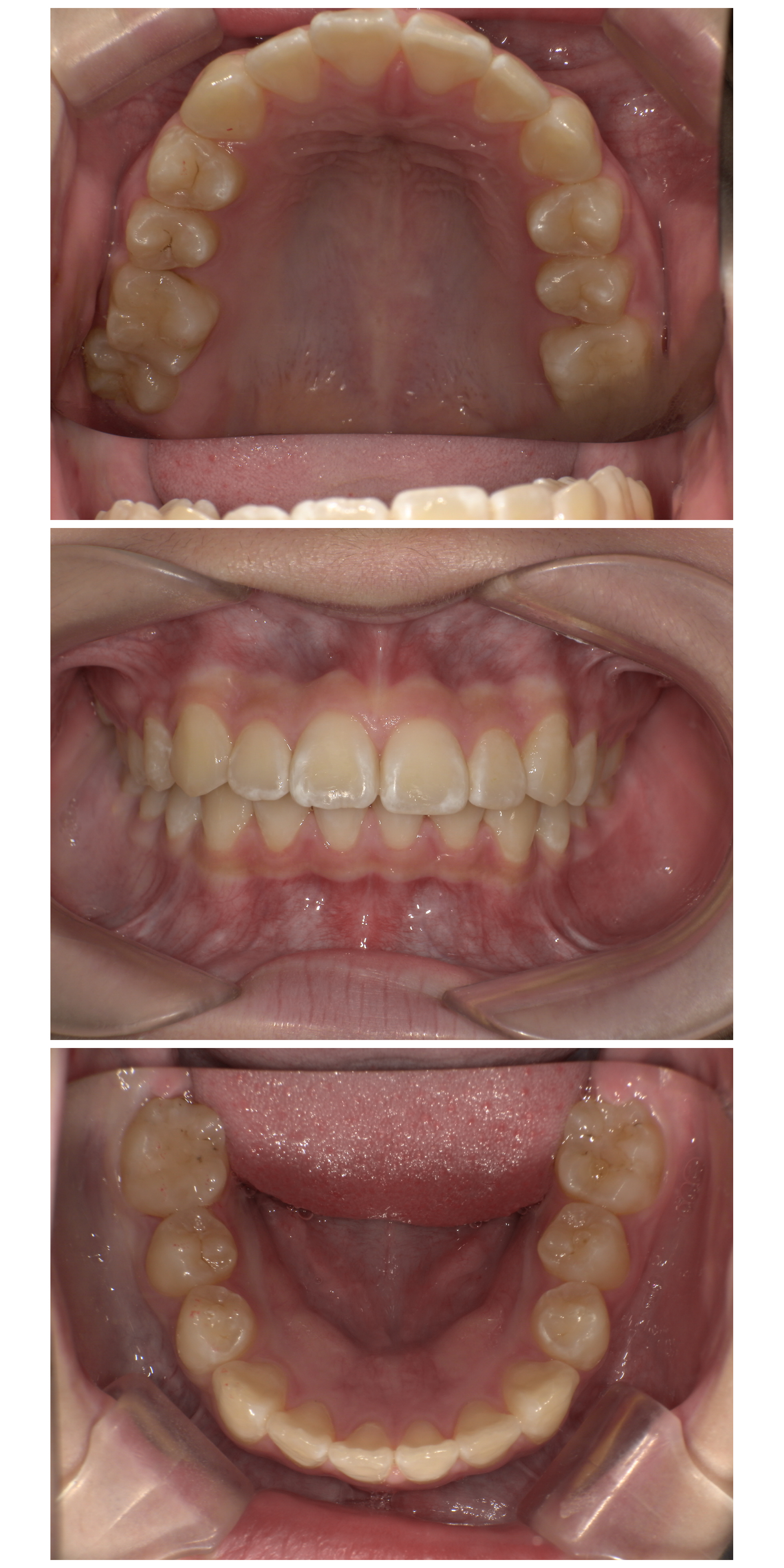 部分矯正症例｜前歯のガタガタが気になる3