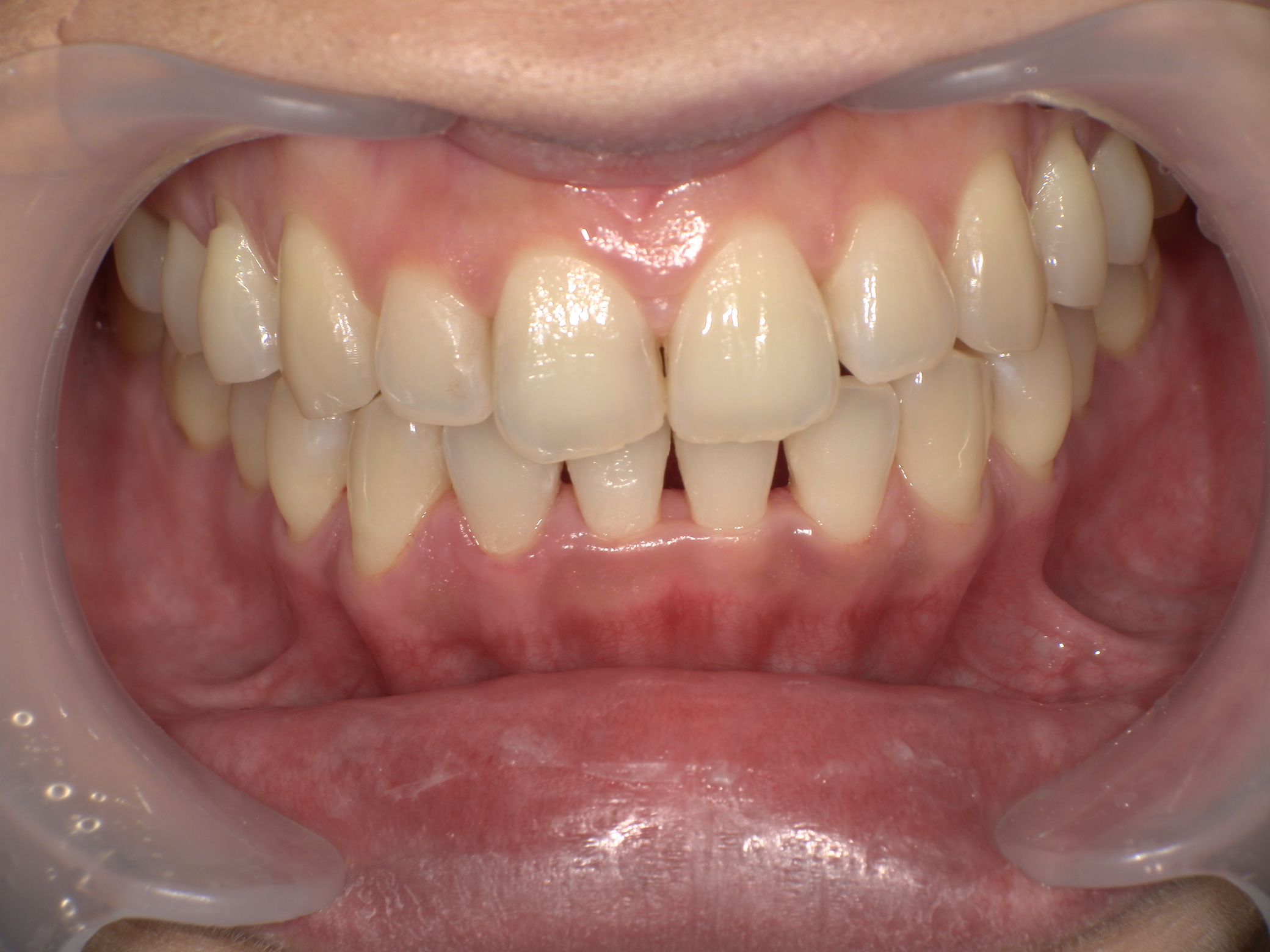 ダイレクトボンディング症例｜矯正後の前歯のすき間(ブラックトライアングル)が気になる