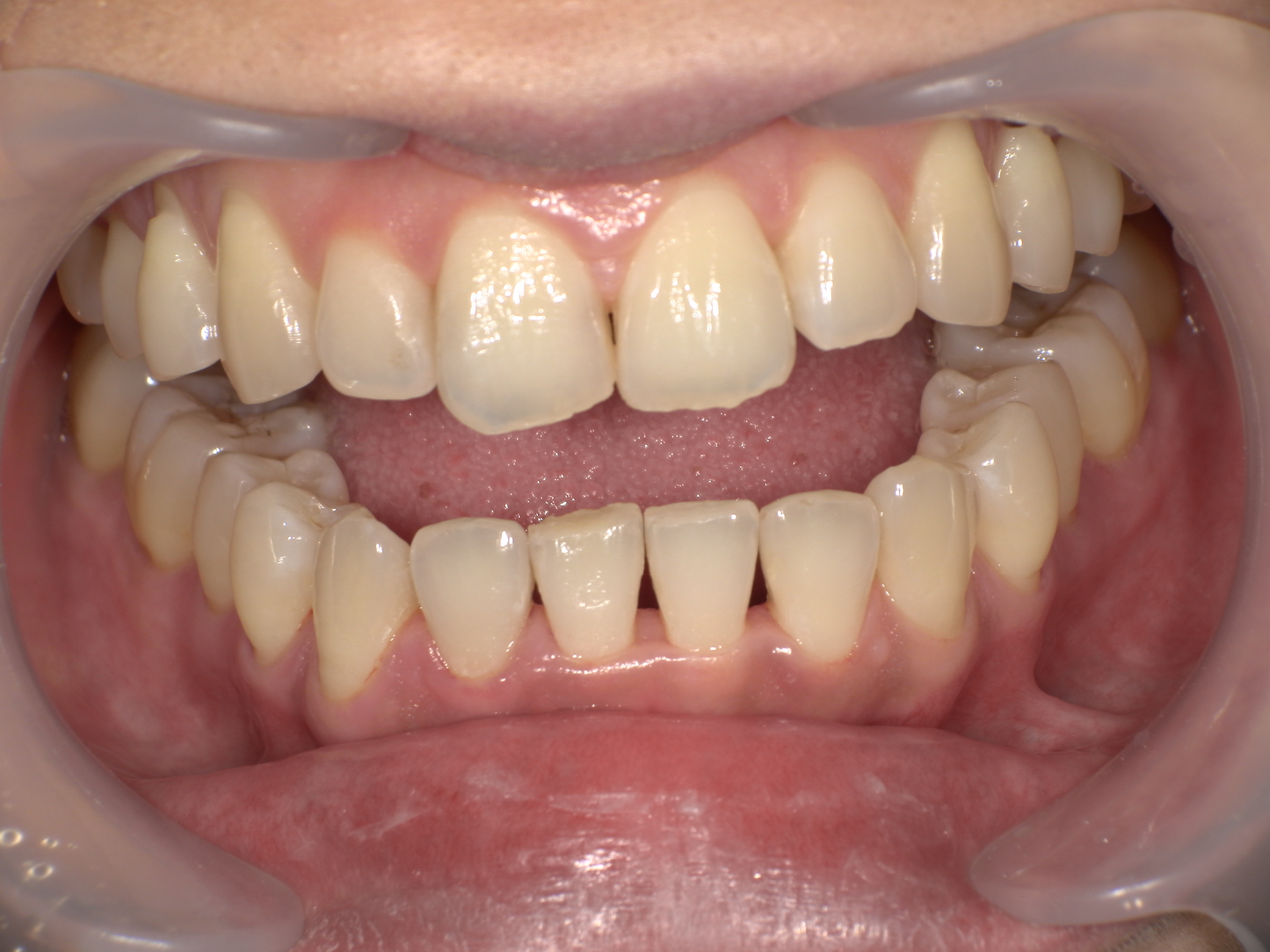 ダイレクトボンディング症例｜矯正後の前歯のすき間(ブラックトライアングル)が気になる2