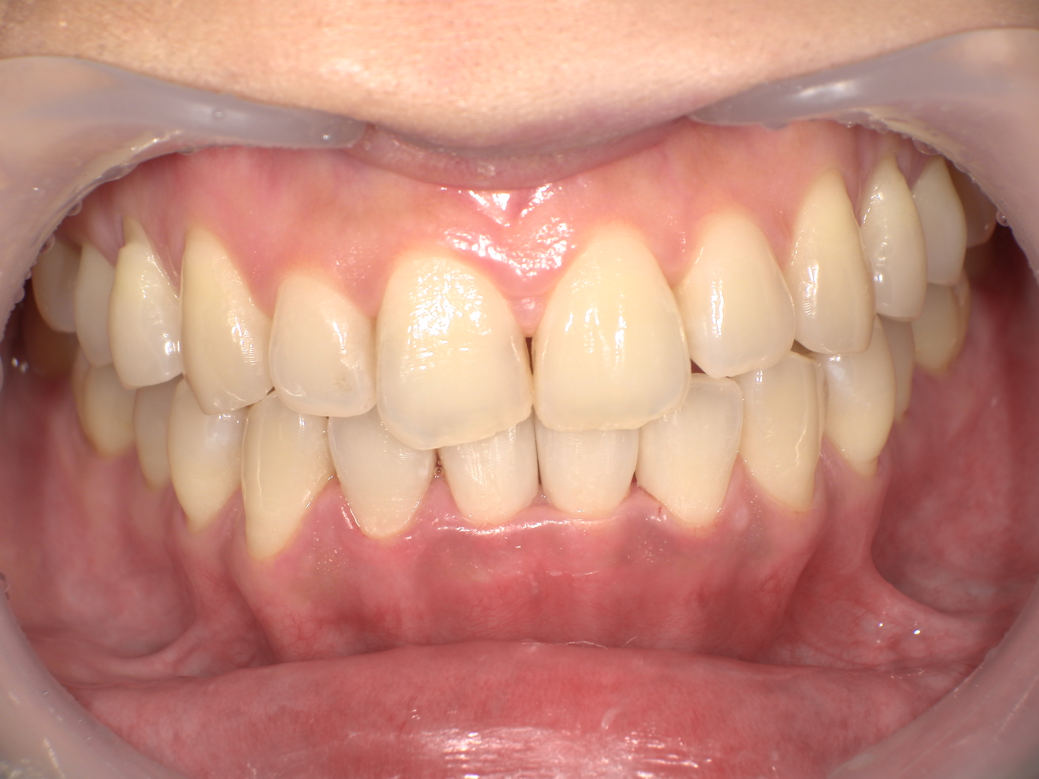 ダイレクトボンディング症例｜矯正後の前歯のすき間(ブラックトライアングル)が気になる3