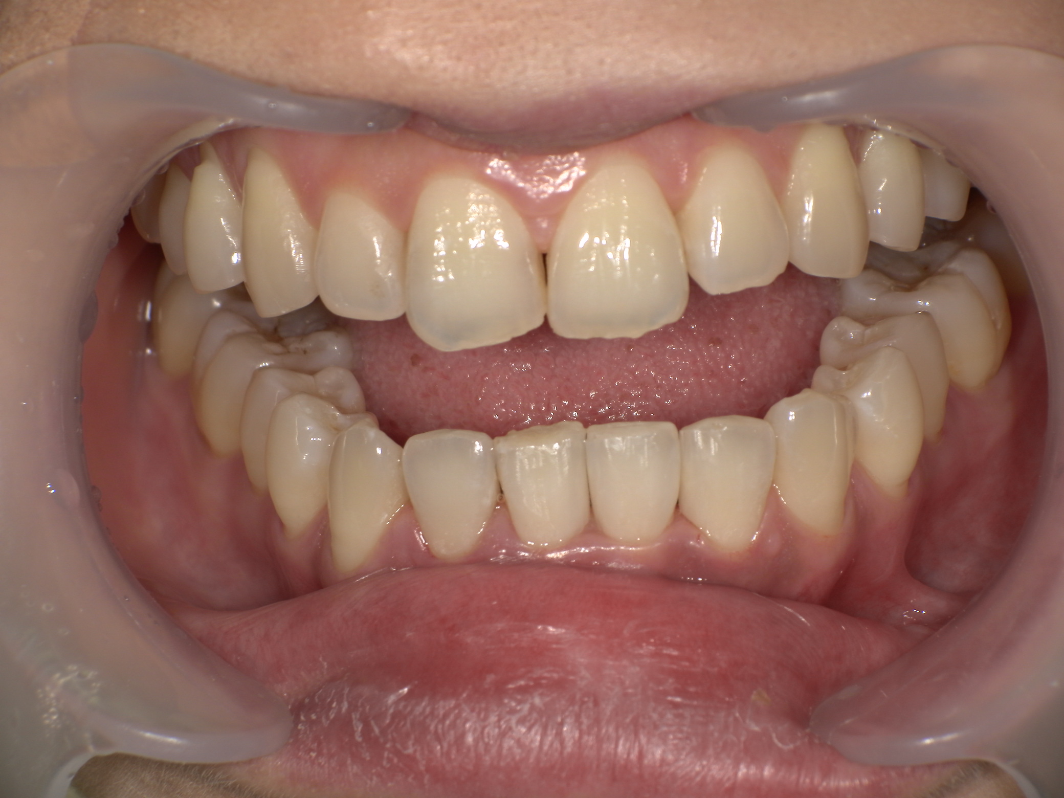 ダイレクトボンディング症例｜矯正後の前歯のすき間(ブラックトライアングル)が気になる4