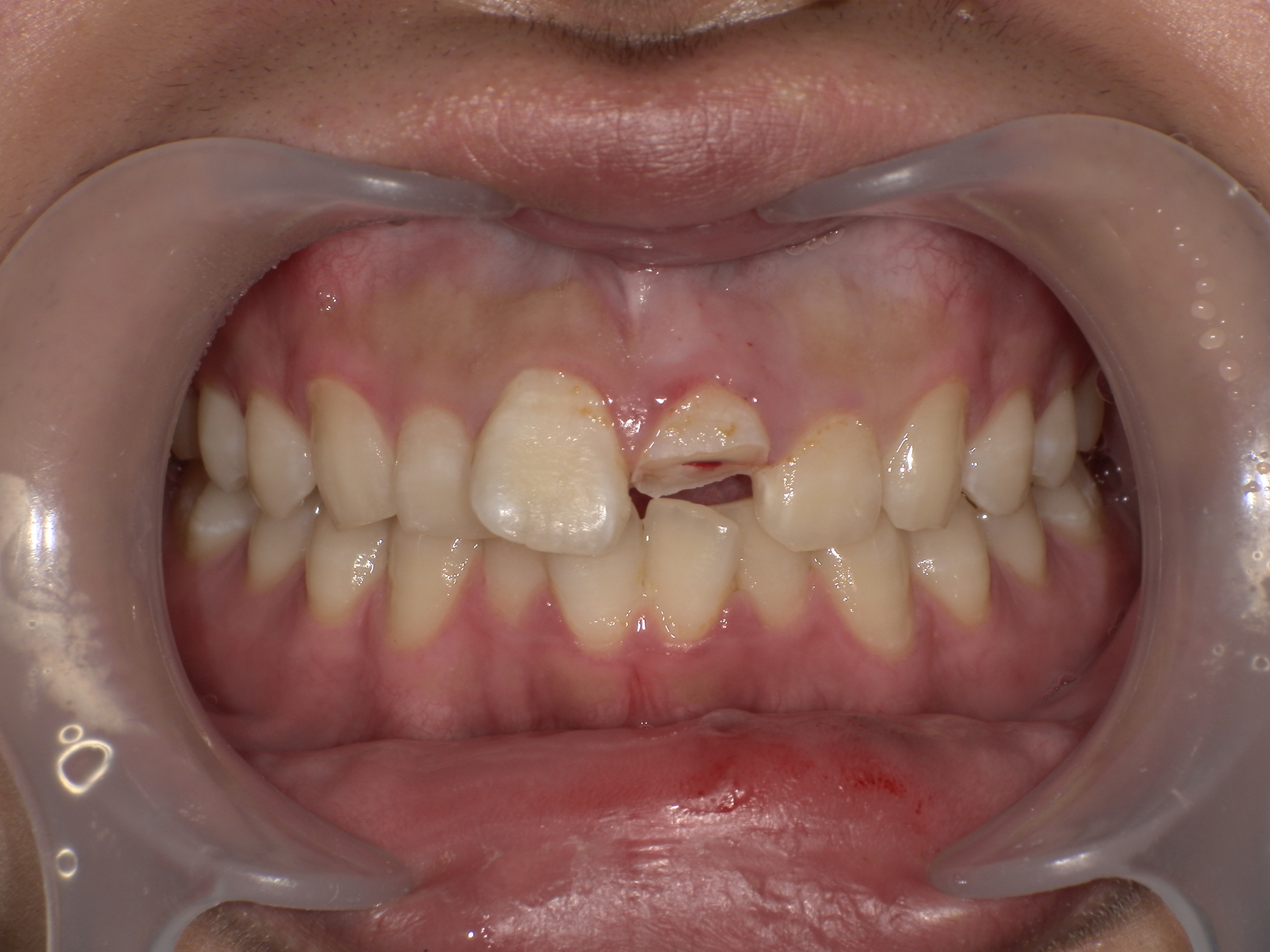 e-max（オールセラミックス）症例｜ケガで前歯が折れた1