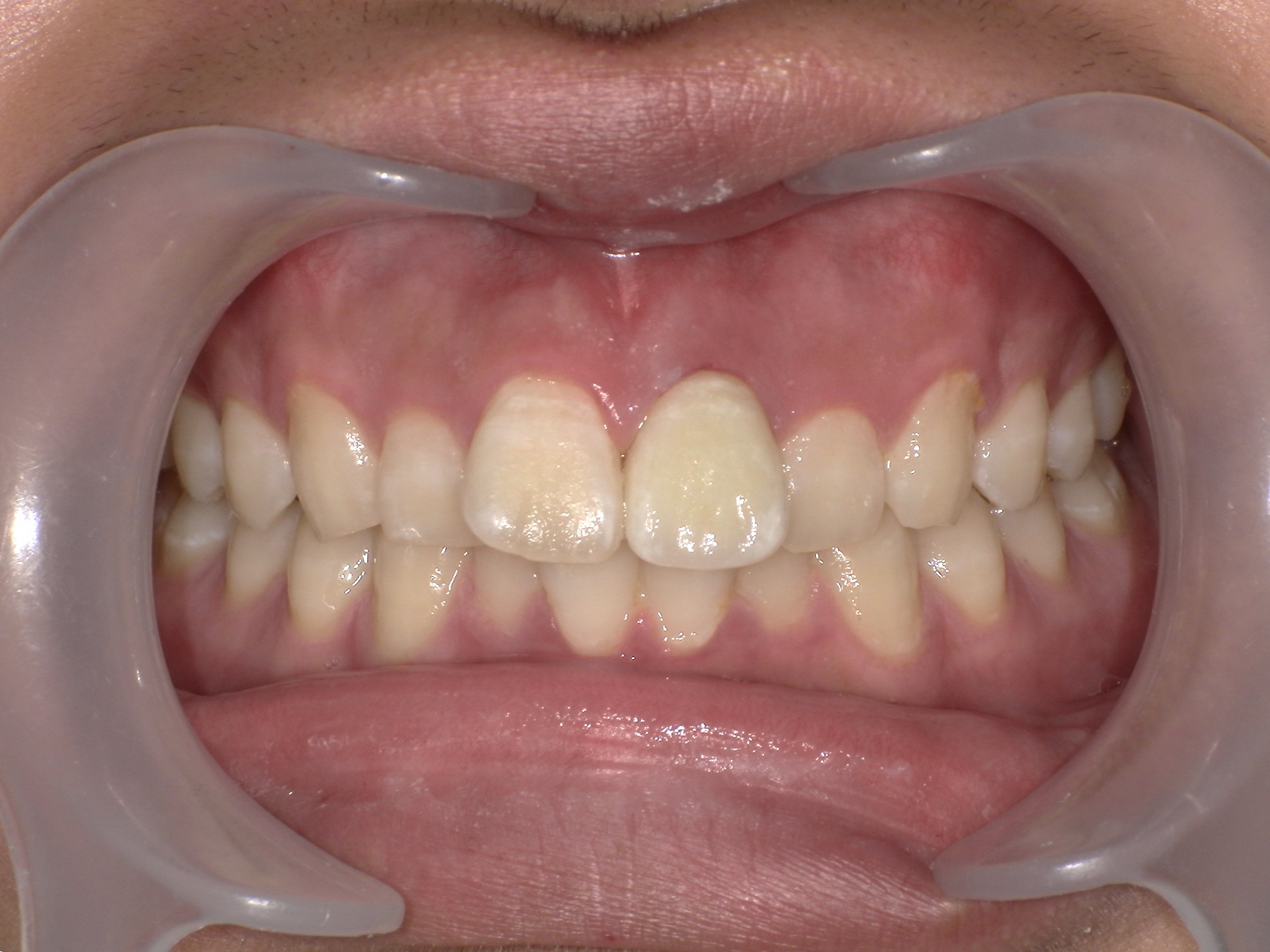 e-max（オールセラミックス）症例｜ケガで前歯が折れた3