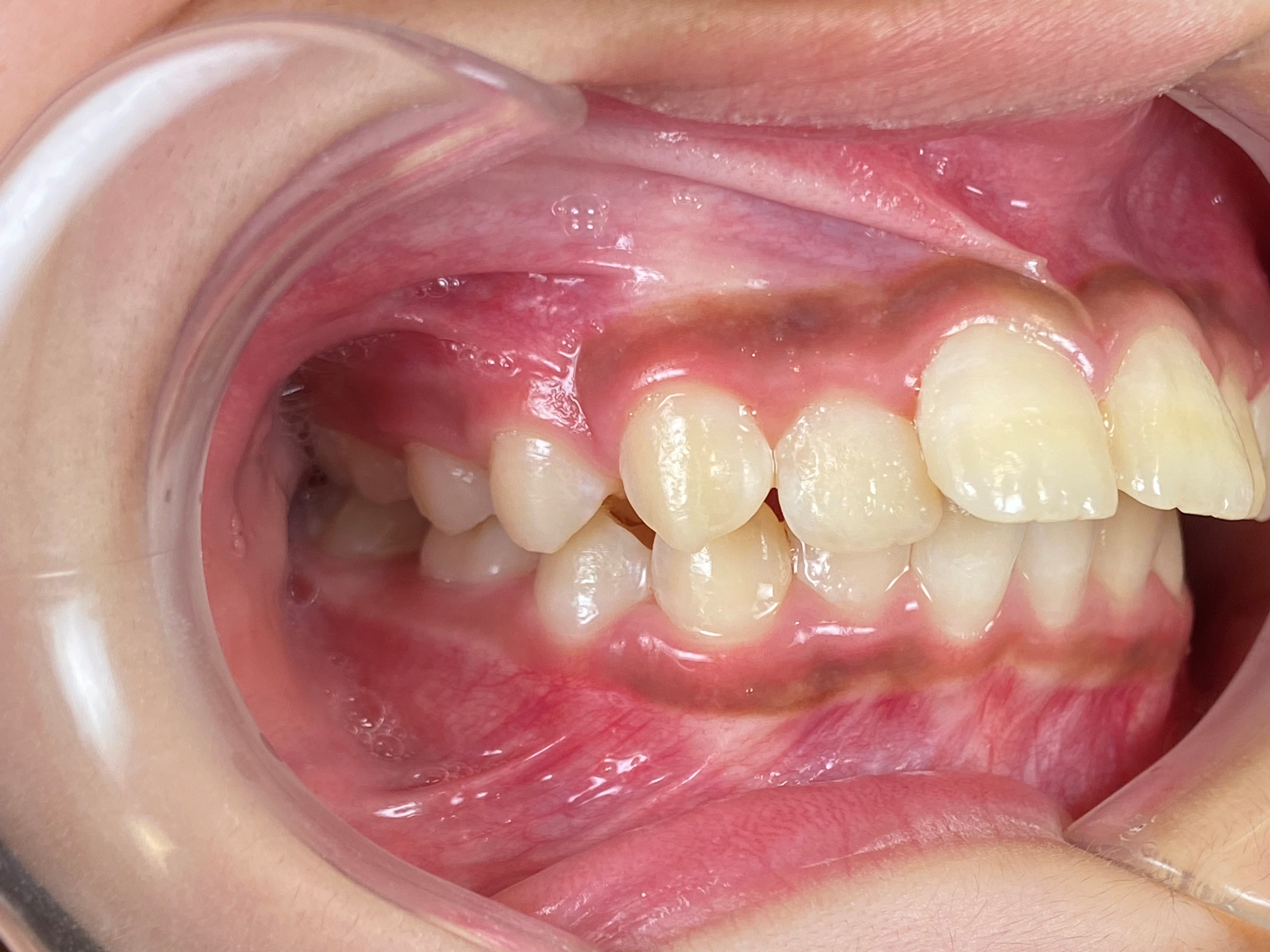 インビザライン症例｜出っ歯になっていることが気になる