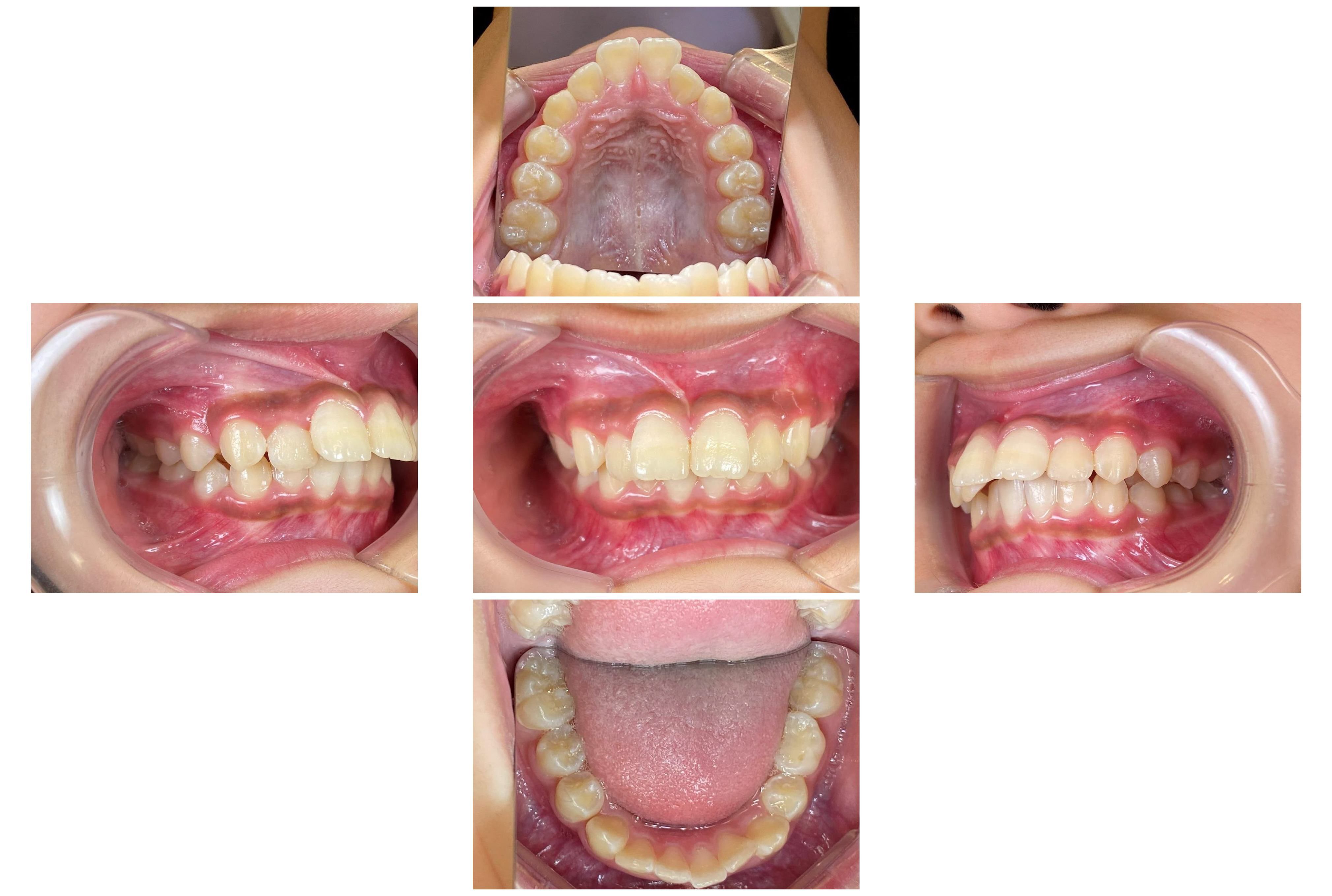インビザライン症例｜出っ歯になっていることが気になる1