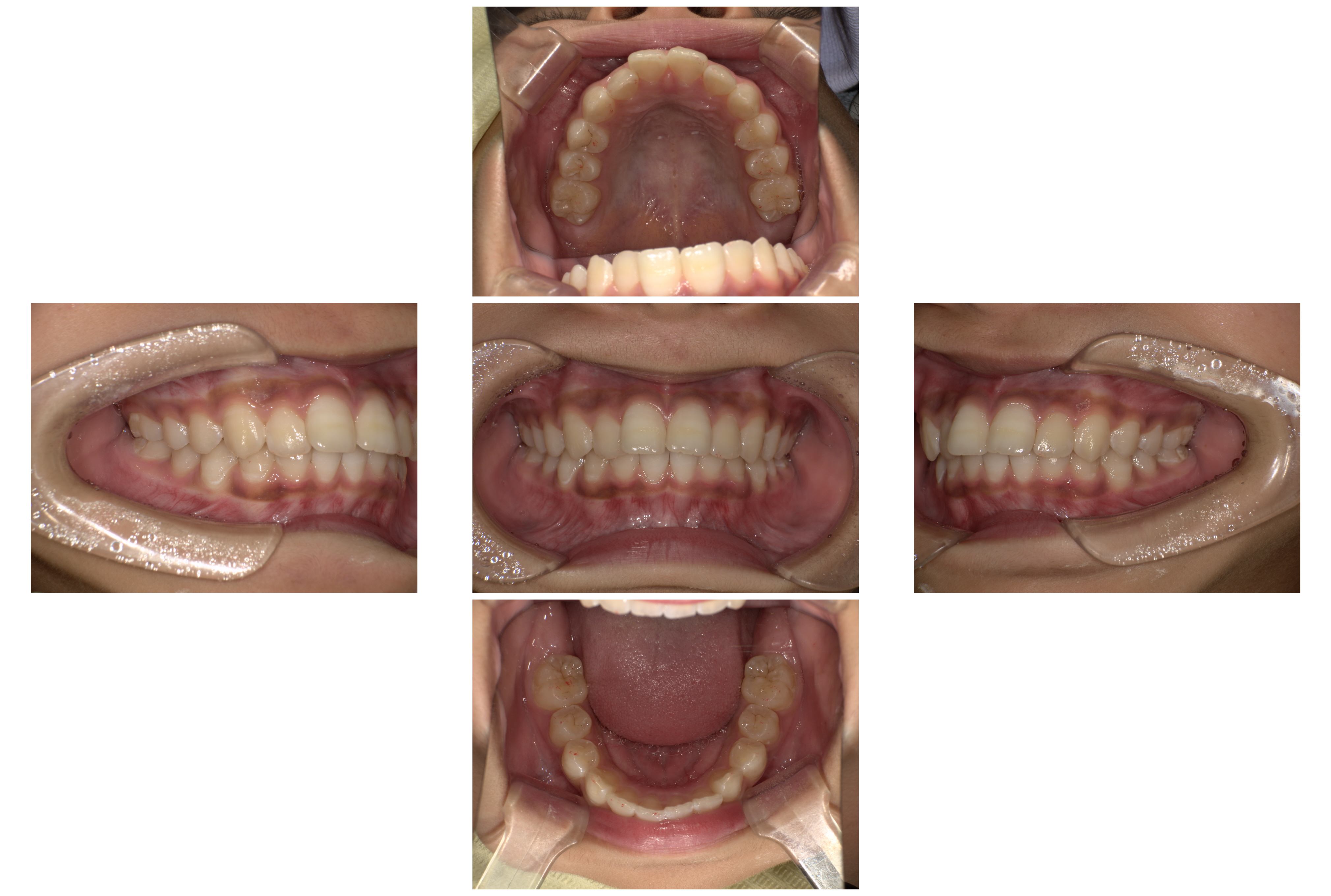 インビザライン症例｜出っ歯になっていることが気になる2