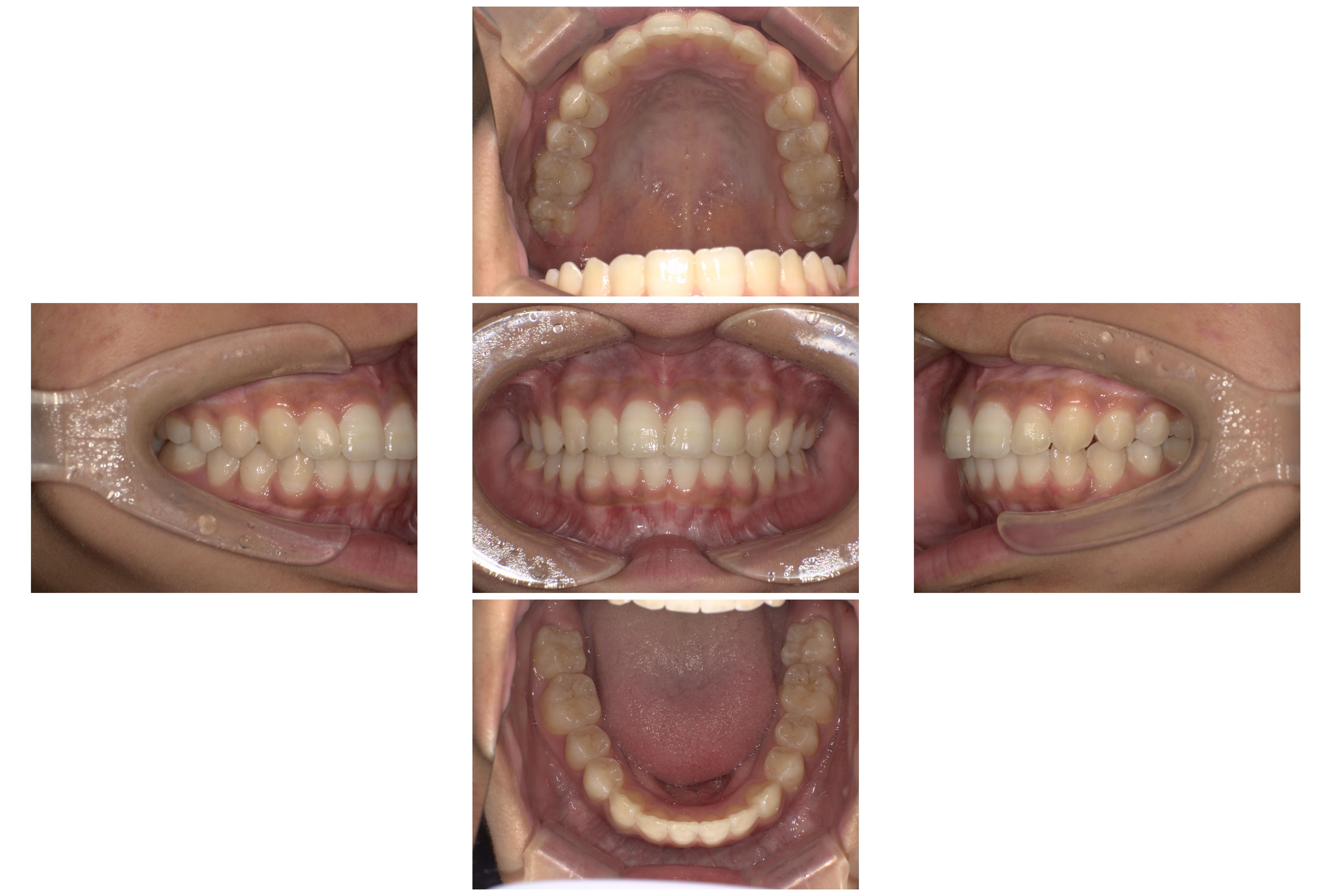 インビザライン症例｜出っ歯になっていることが気になる3
