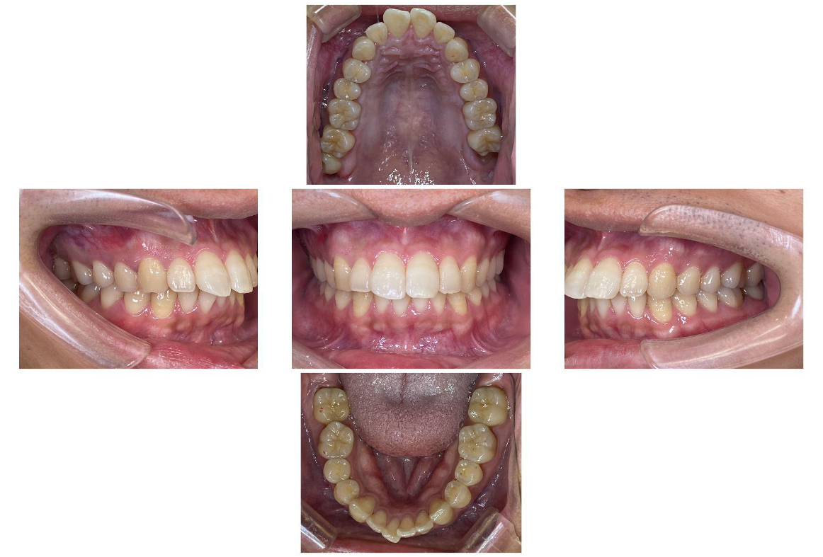 出っ歯な感じが気になっている（上顎前突症例）