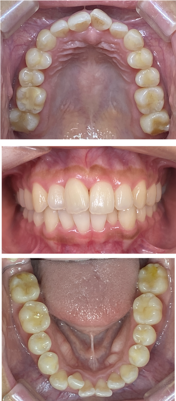 前歯のガタガタが気になる（叢生症例）：部分矯正症例