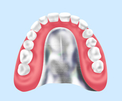 金属床（自費診療の入れ歯）