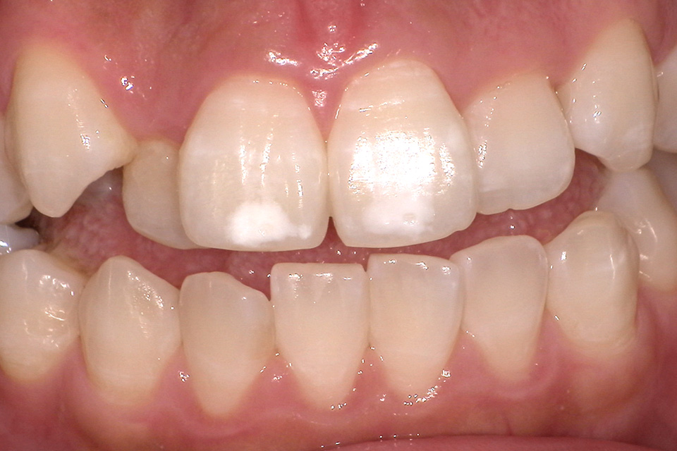 ホワイトスポットの原因