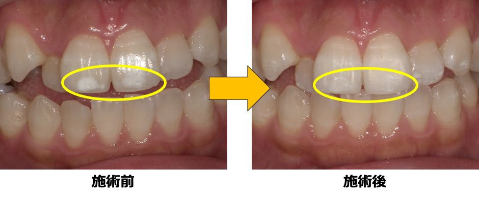 症例1：エナメル質形成不全によるホワイトスポット