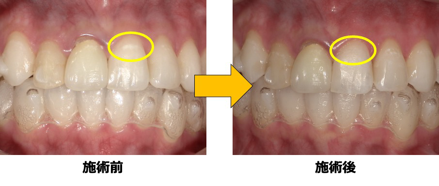 症例2：初期虫歯によるホワイトスポット