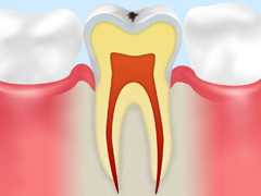 C0　ごく初期のむし歯