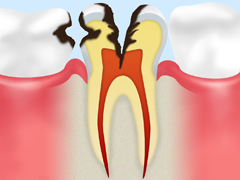 C3　神経まで達したむし歯