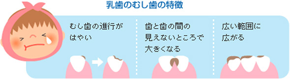 理由：乳歯のむし歯予防が重要だから