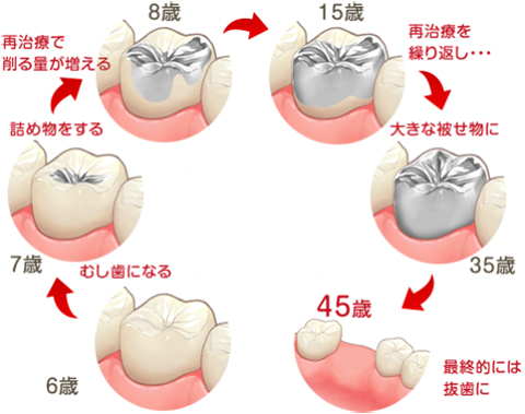 理由：乳歯のむし歯予防が重要だから